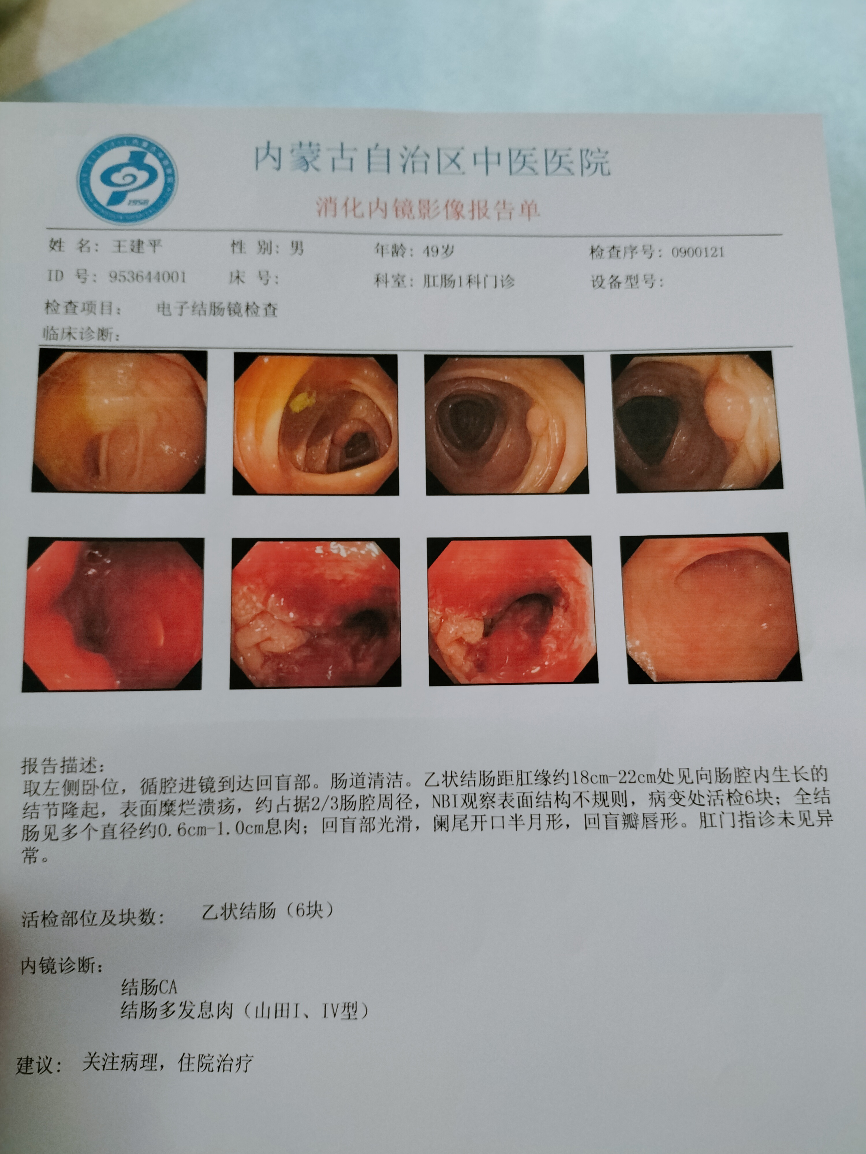 病友交流中心# 医生说我是乙状结肠结节肿瘤,必须手术切了,这种情况
