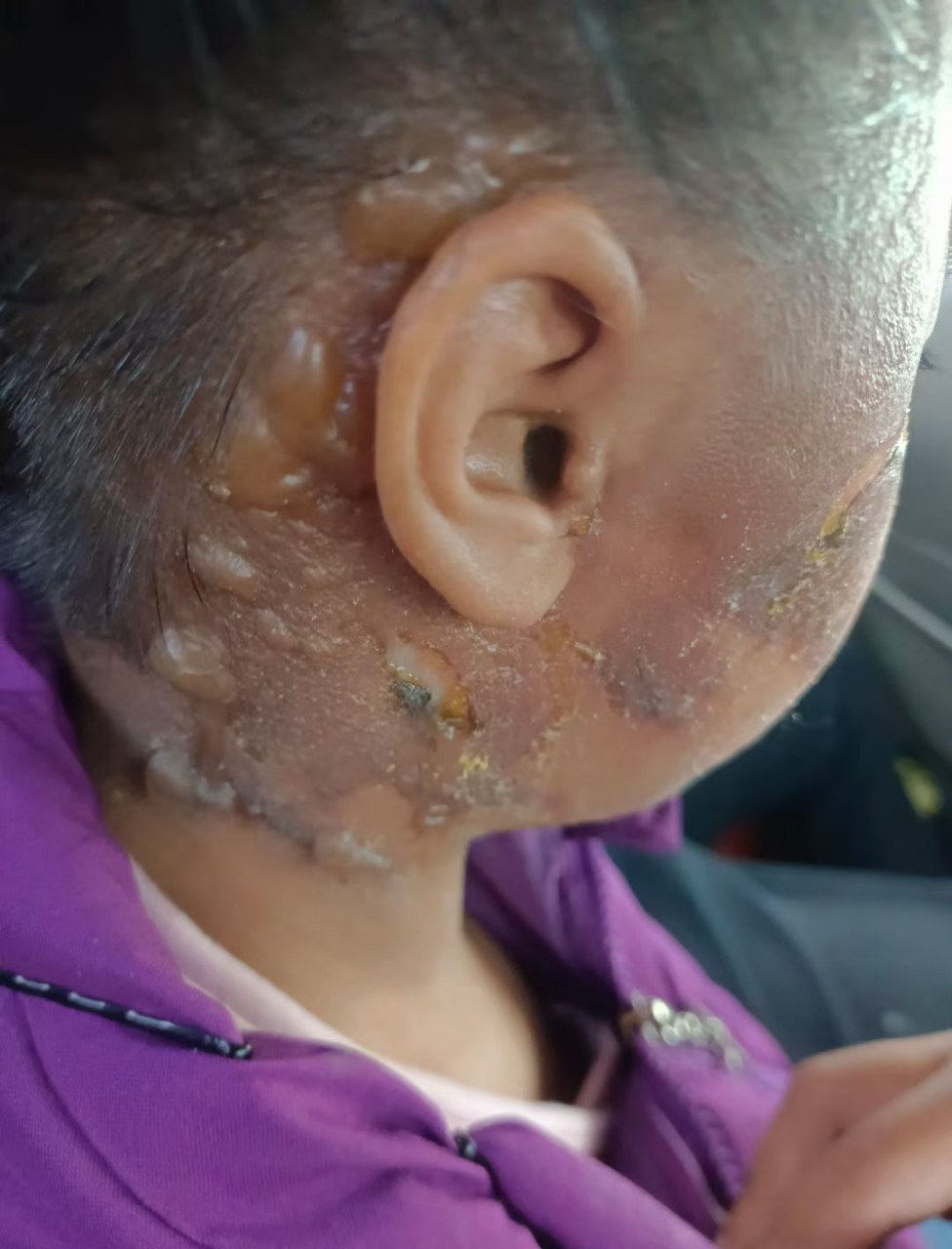 太可怜了,邻居的小女孩不小心被开水烫到,她才6岁啊,去医院看就上上药