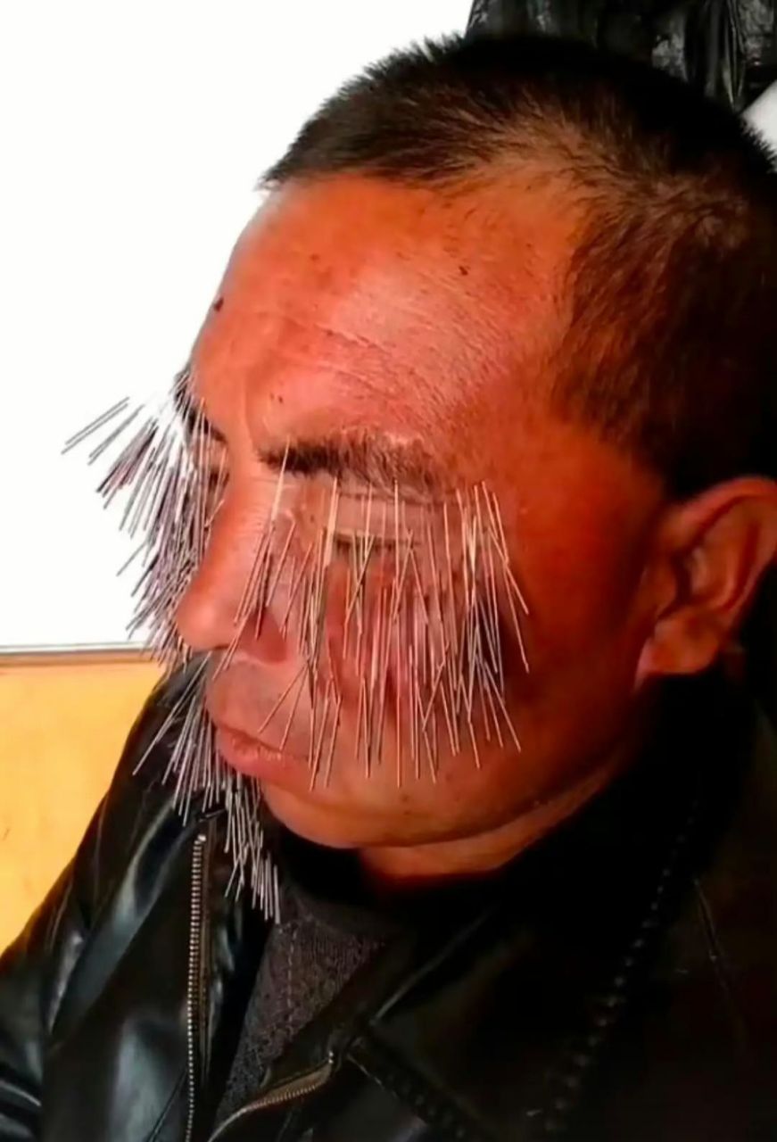 这样扎针灸真的能治眼皮跳吗?