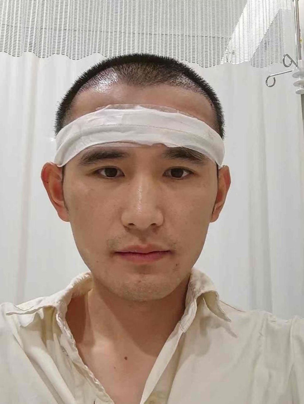 迫不及待的分享他,上海植发一年效果