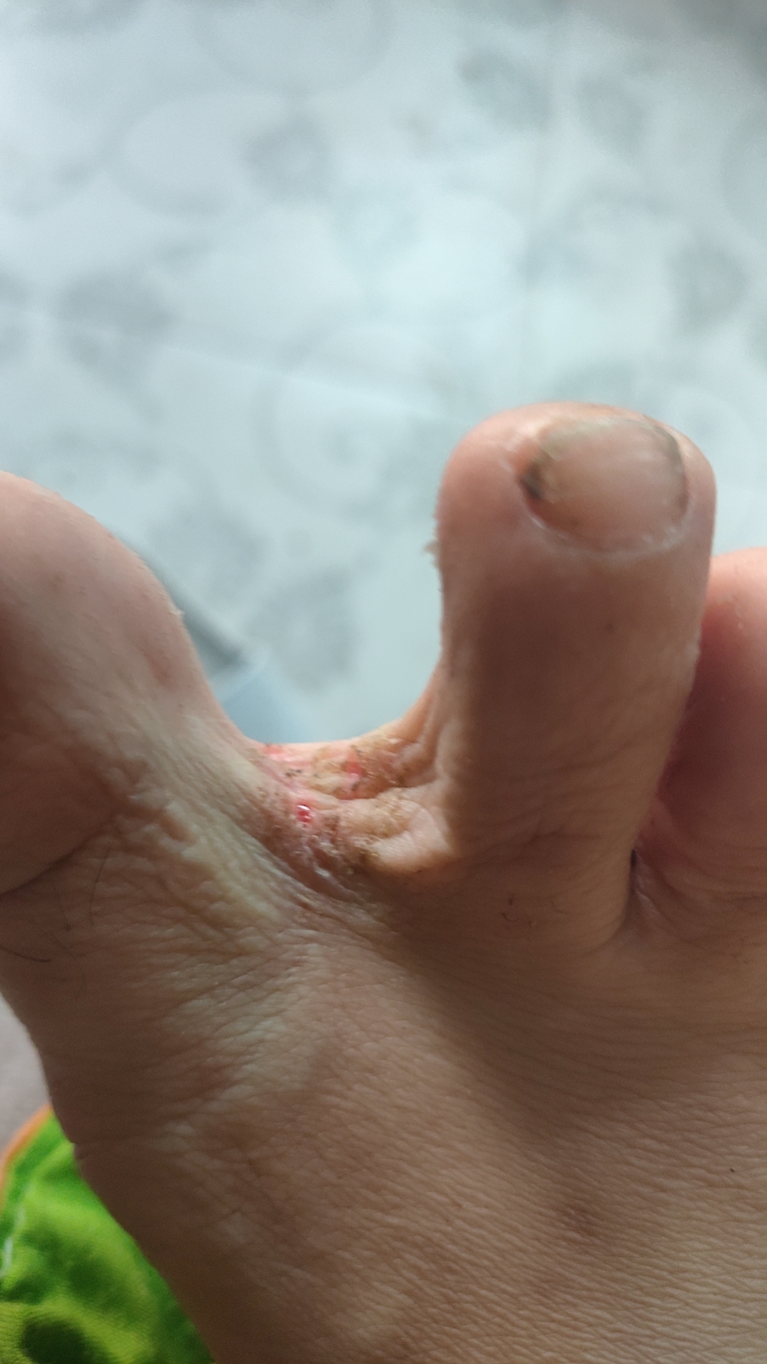 在食品厂上十二小时的班,每天穿上胶鞋在车间脚慢慢的烂成这样