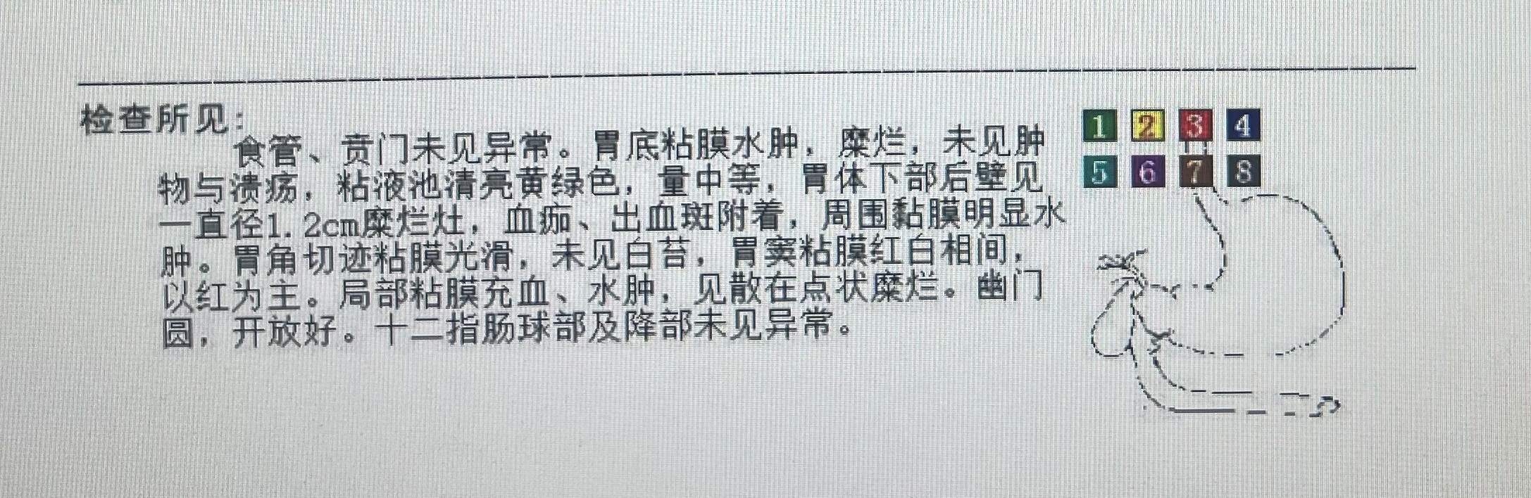 胃出血诊断书 真实图片