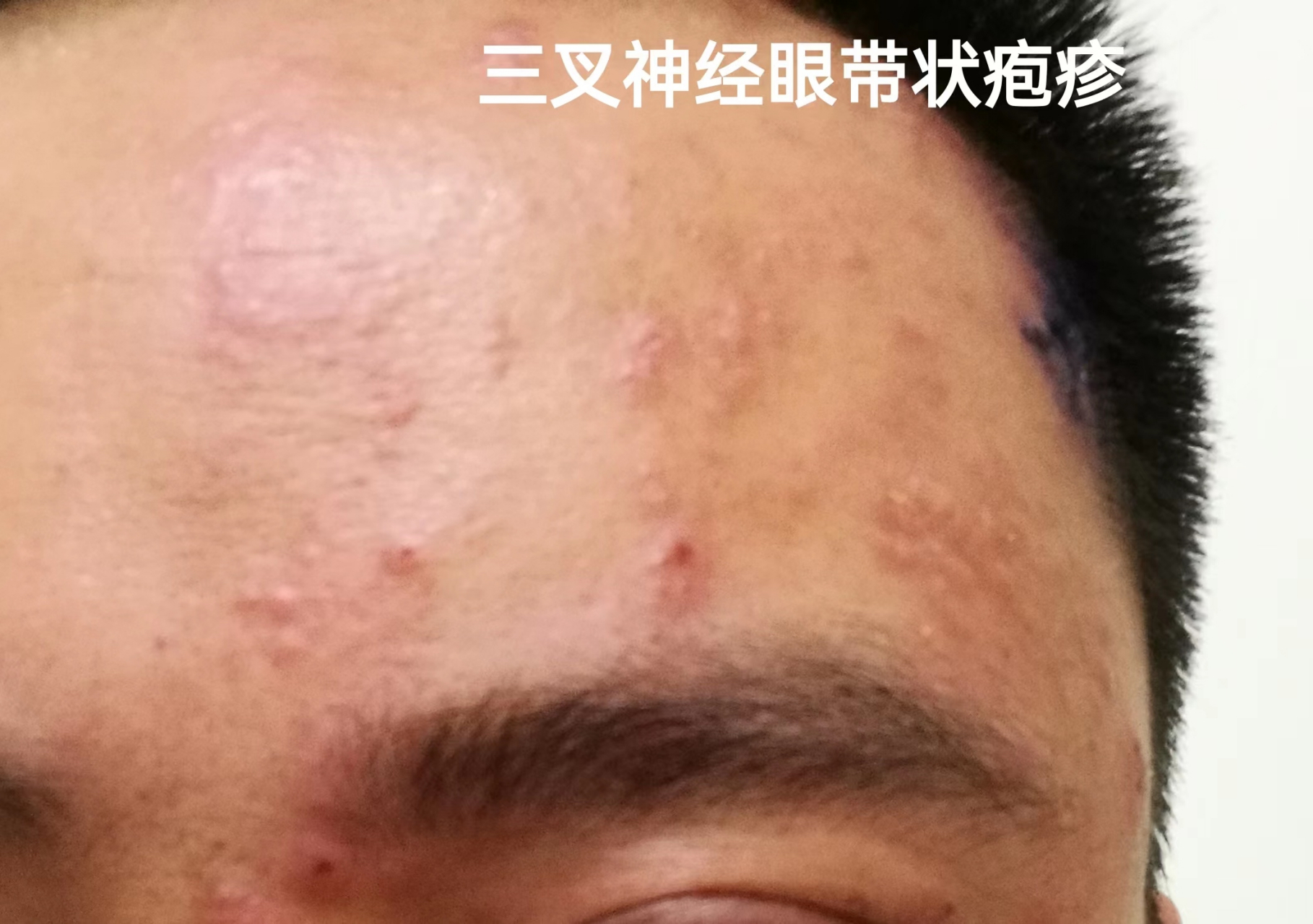 头上长的带状疱疹疼起来最要命,也最容易留后遗症#带状疱疹 长在