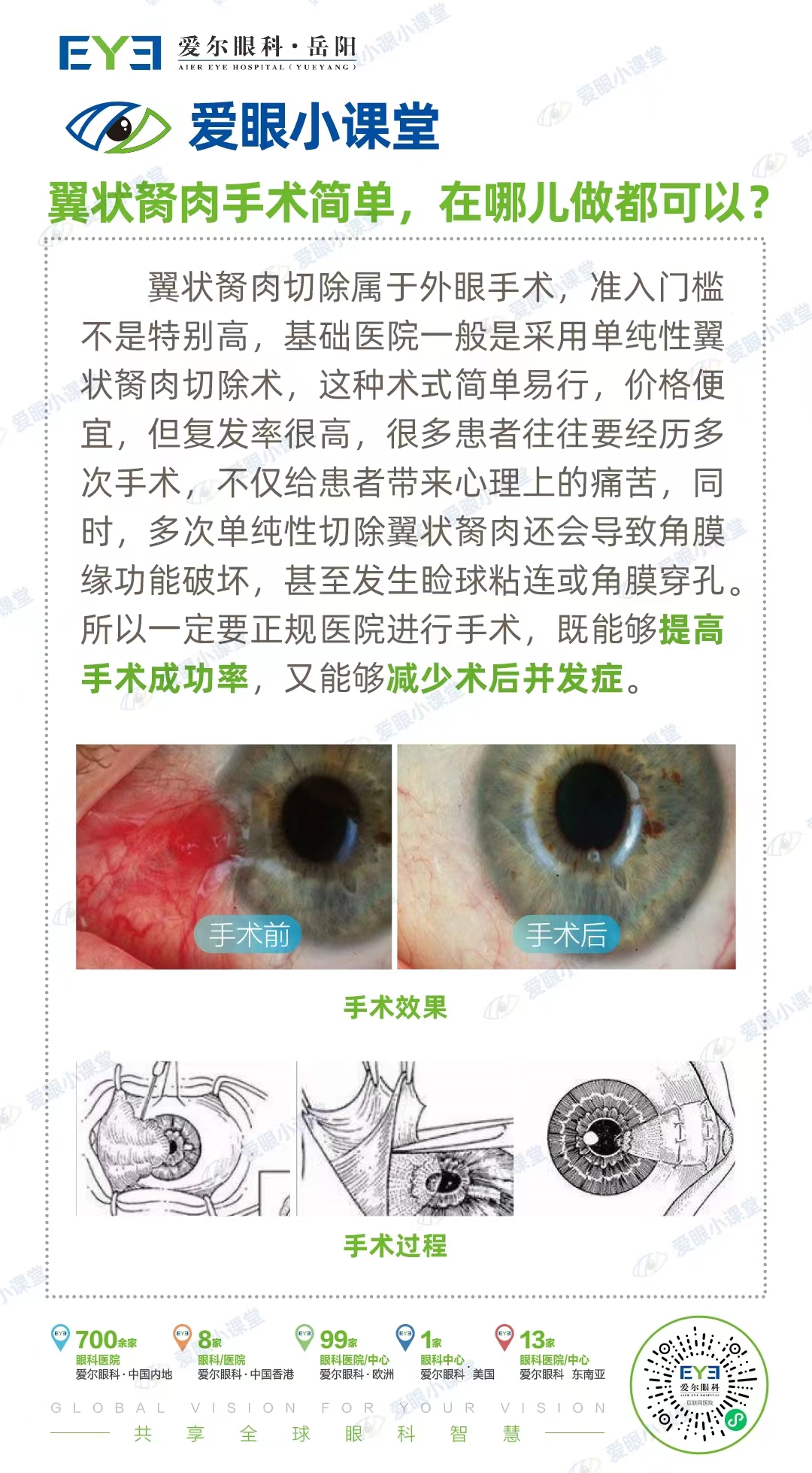 翼状胬肉手术多少钱图片