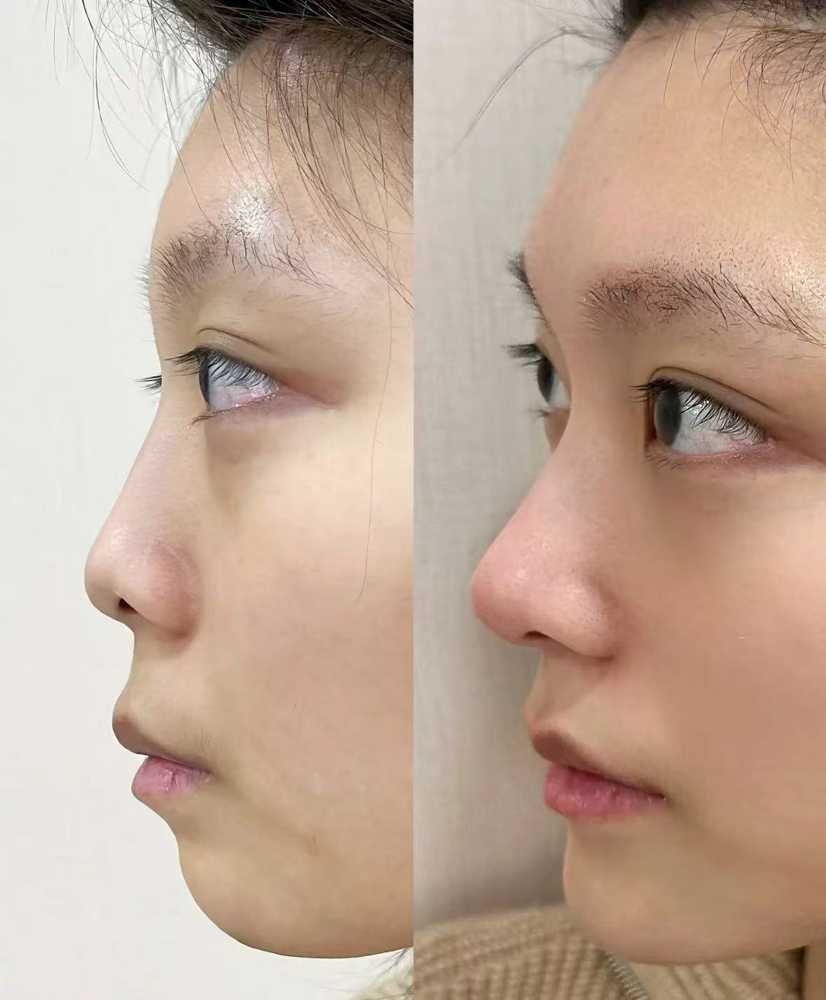 颜值当道,美鼻来袭 完美小翘鼻,精致而灵动 私人定制,综合设计 精致