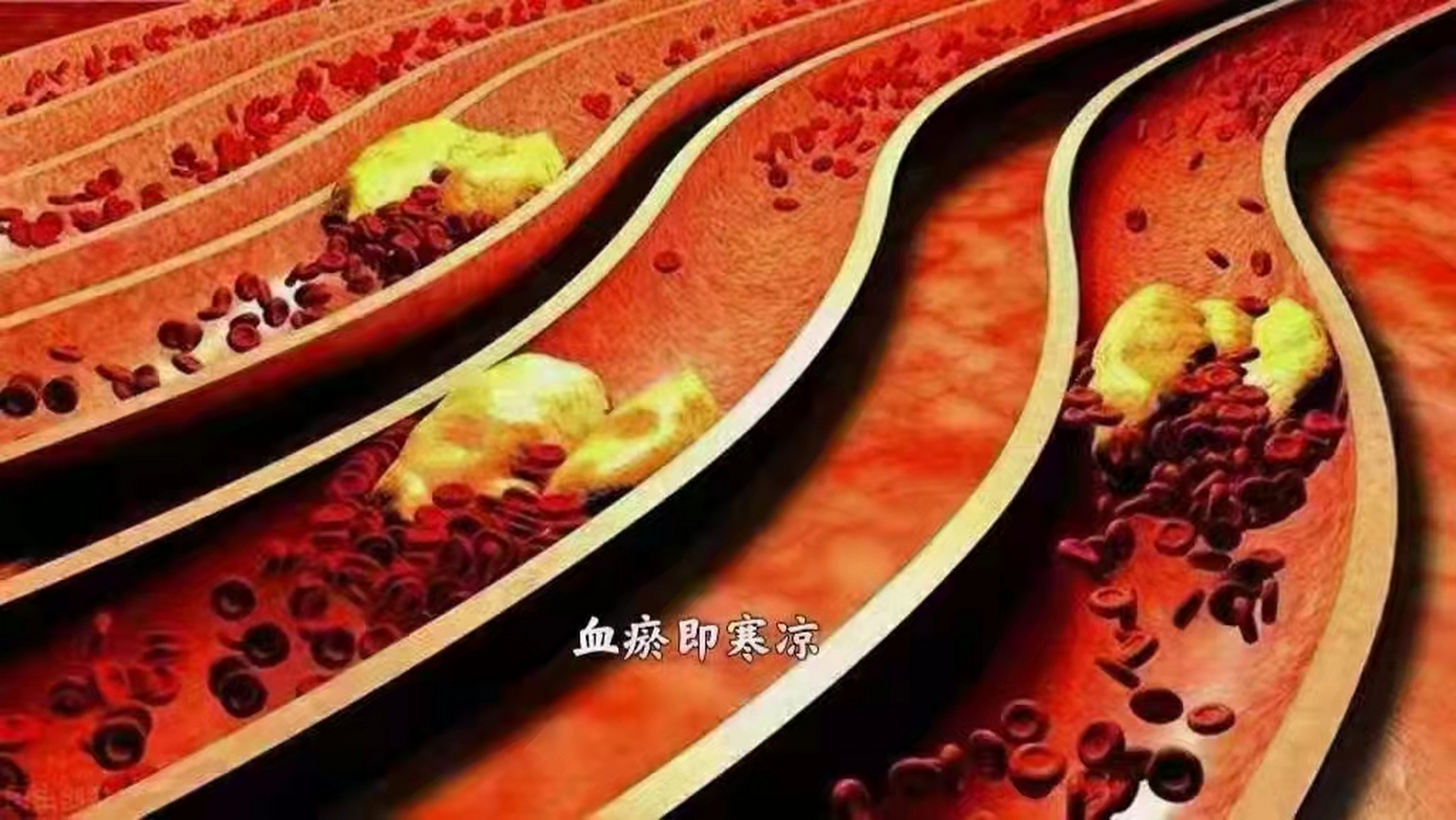 【简谈血瘀】 简言之,血流不畅即血瘀,也就是"寒凉的地方"会引起疾病.