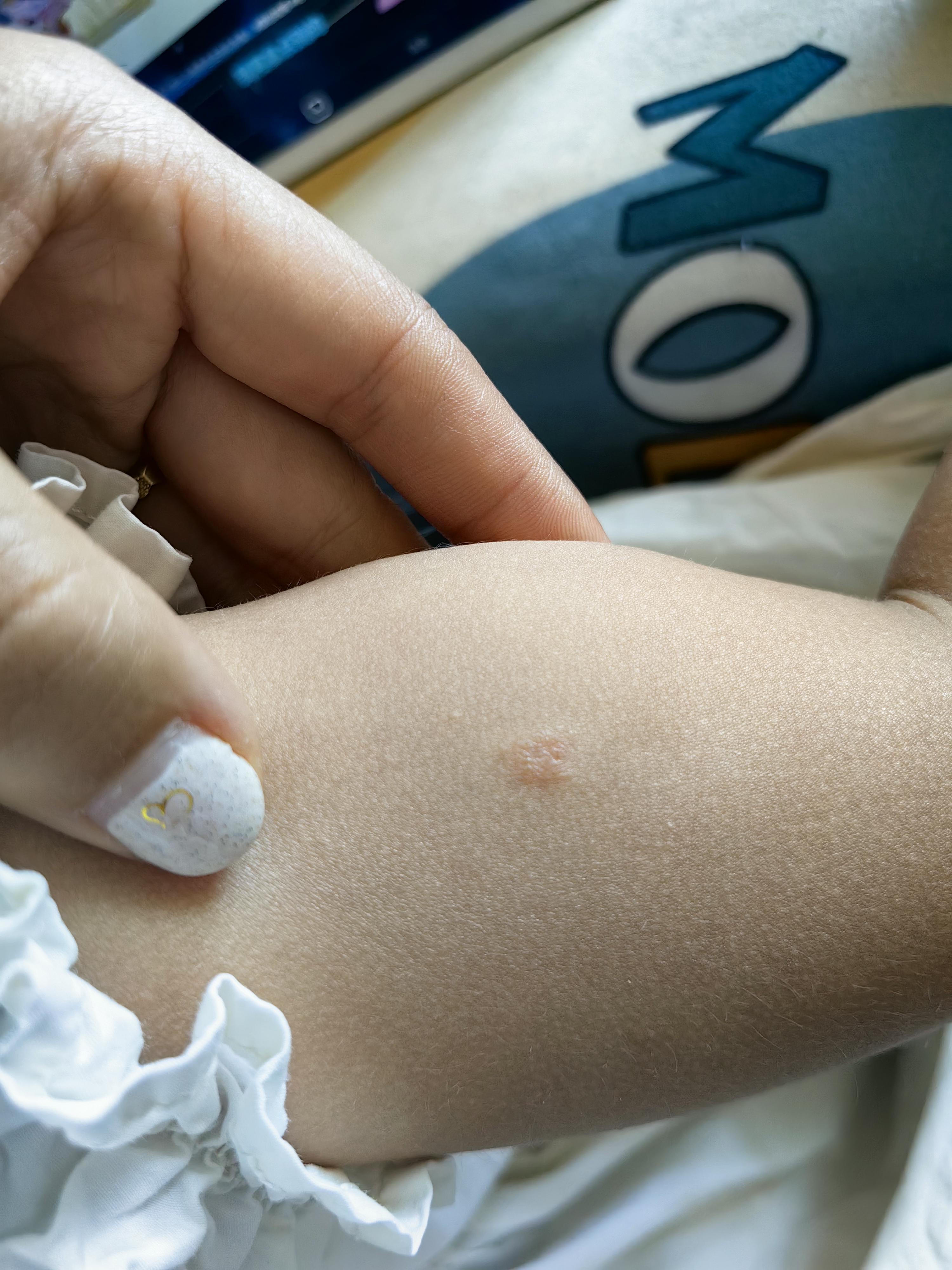 手臂上一个月前是一个无色的痘痘,有轻微脱皮,当时涂点身体乳下去了