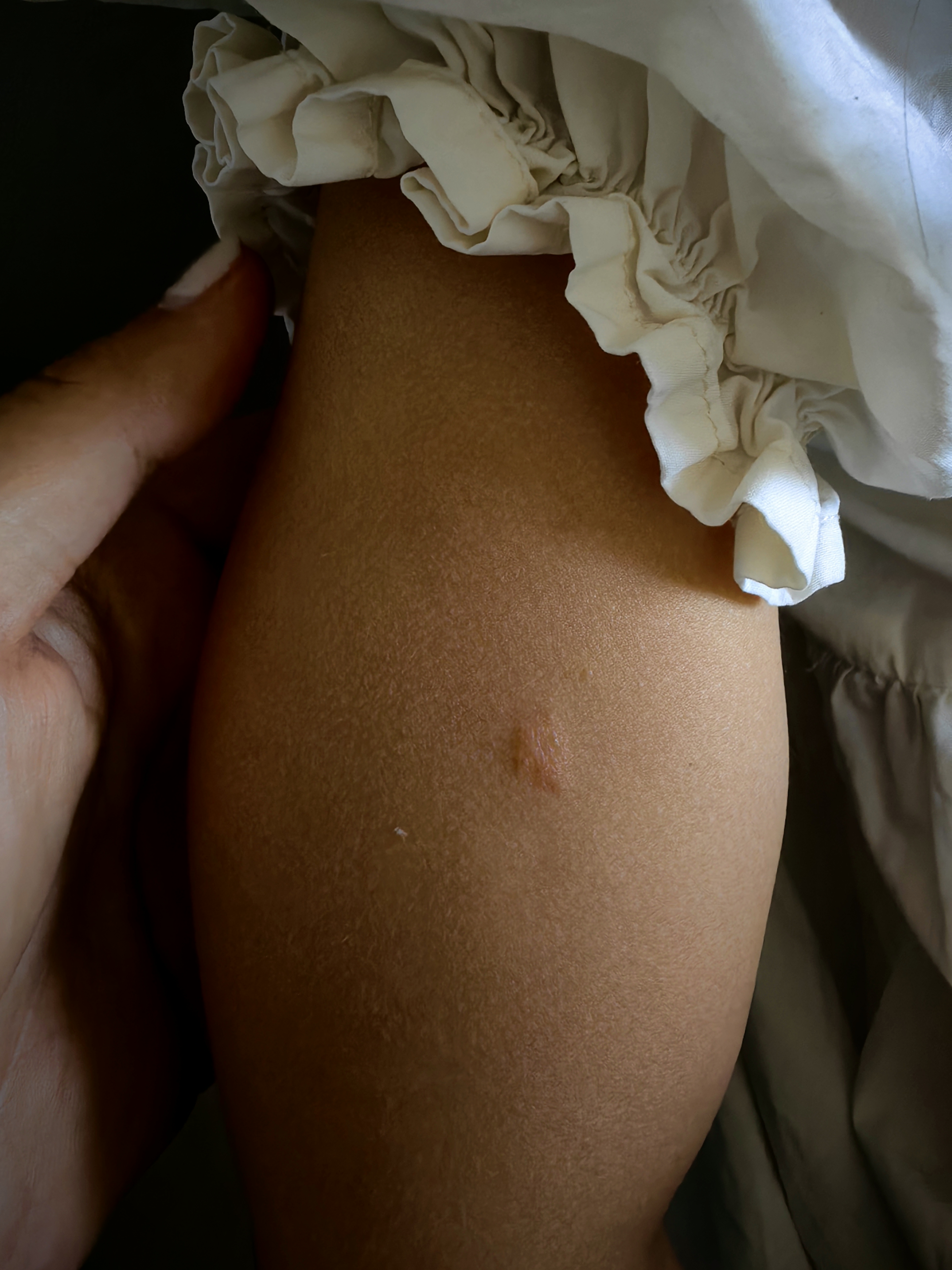 手臂上一个月前是一个无色的痘痘,有轻微脱皮,当时涂点身体乳下去了