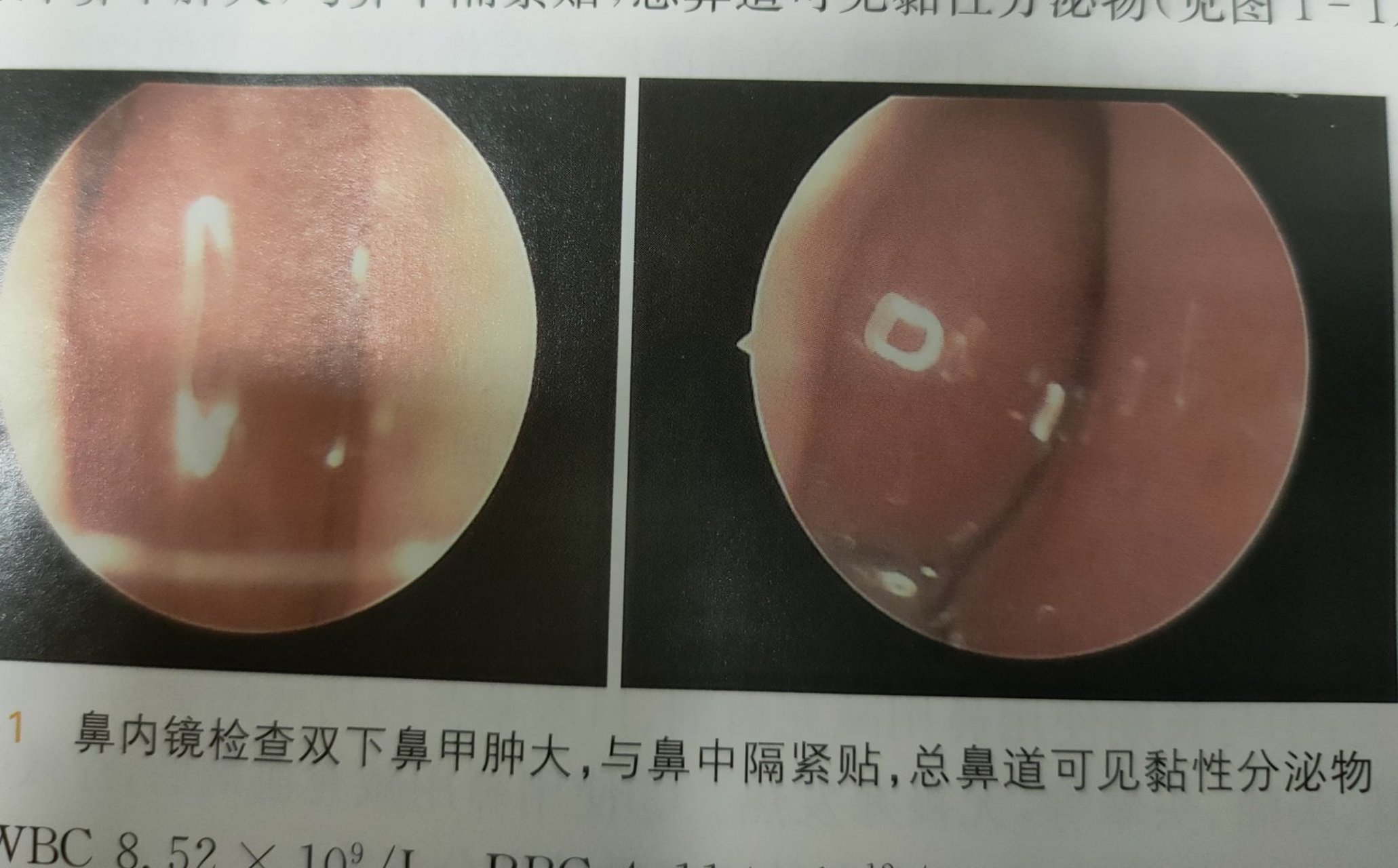 鼻炎# 鼻内镜下观察到的急性鼻炎