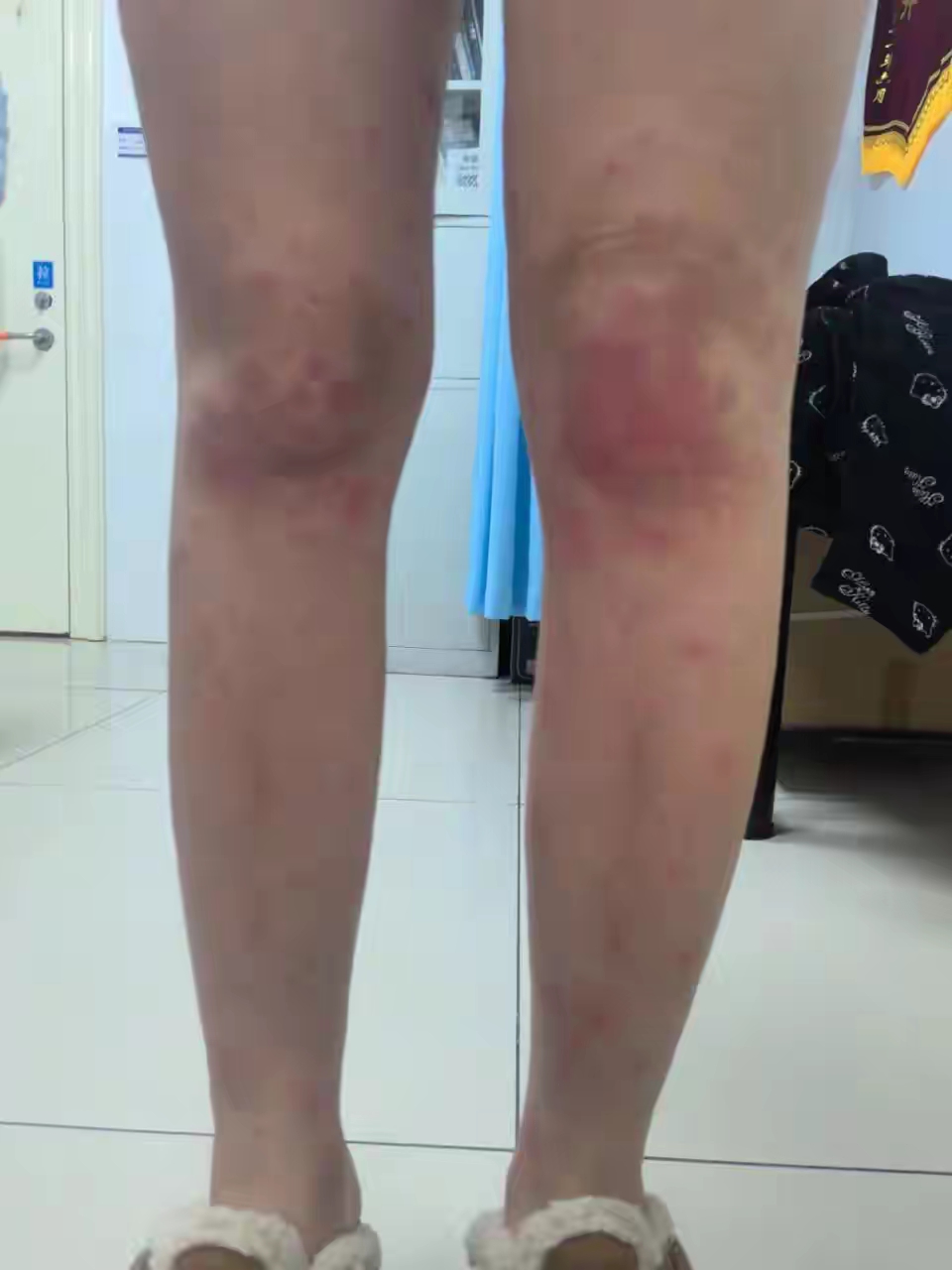 湖南长沙的李女士春节期间爱穿短裙,光腿或套层薄丝袜