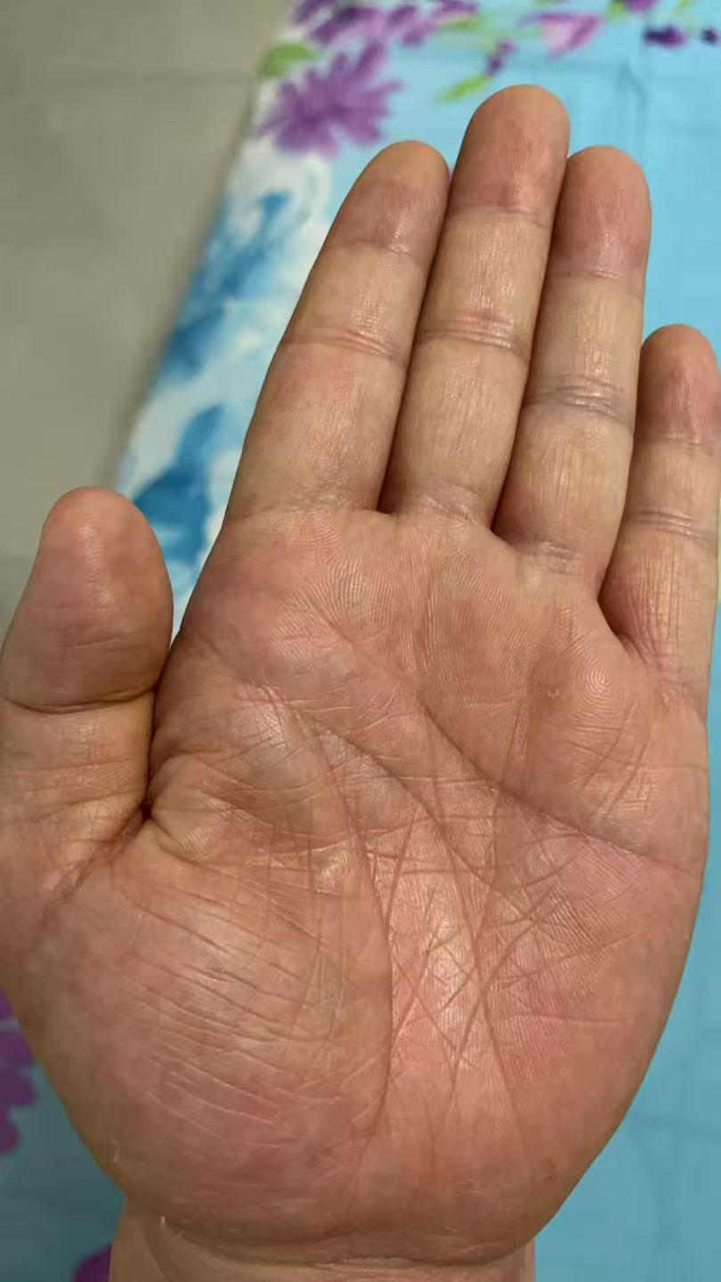 虽有通天纹,但是财库封财不严,巽宫干硬,虎口青筋,注定事业和财运比较