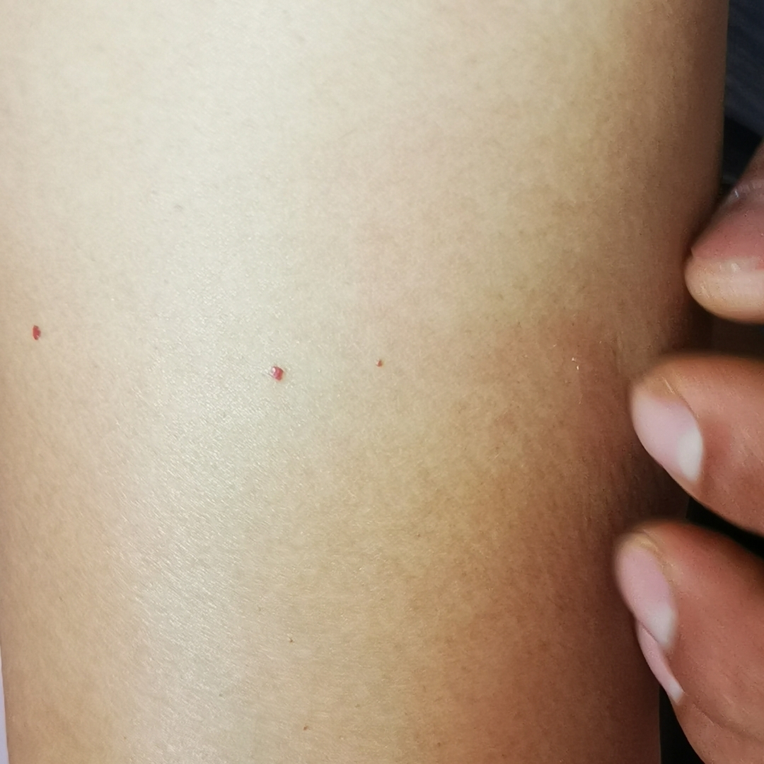 身上胳膊上有这小红点是什么原因