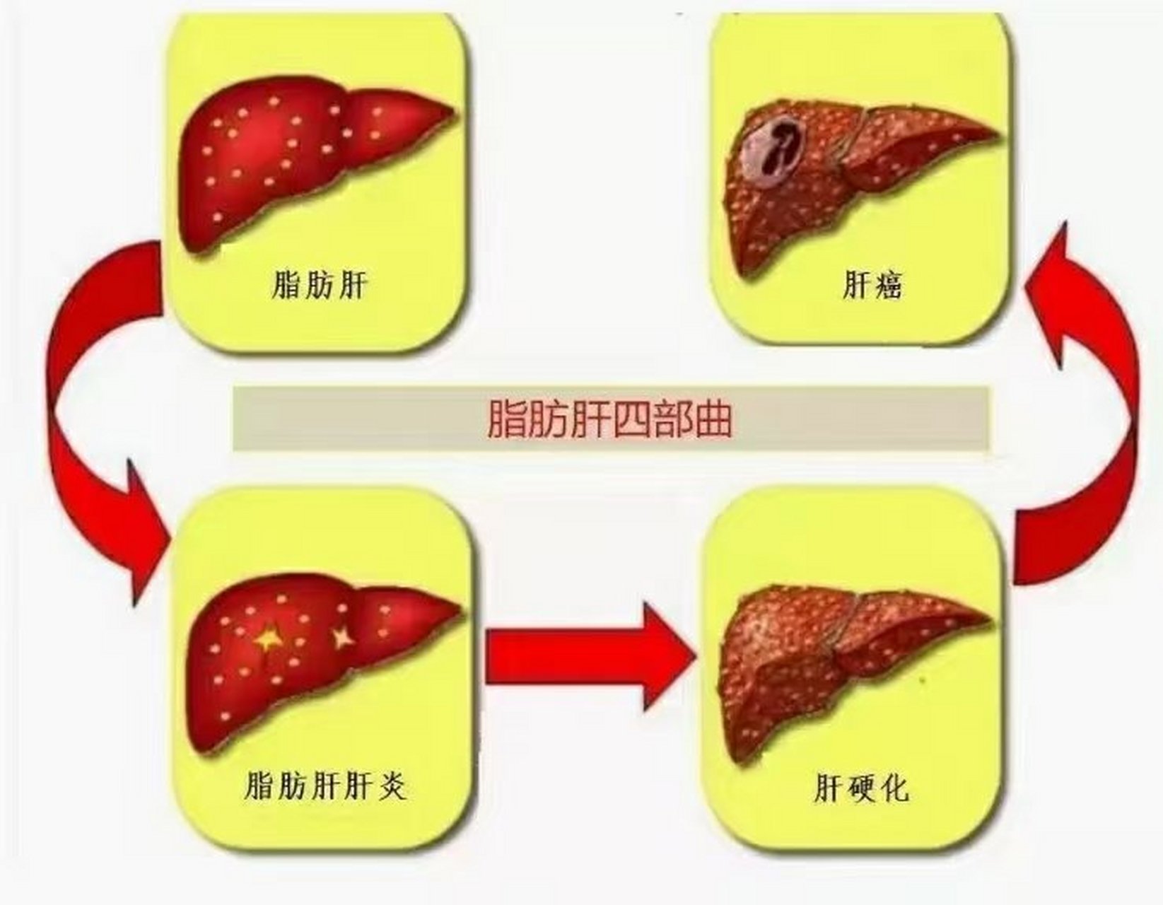 脂肪肝,四部曲[微笑 q 每一步之间相差3年左右[咖啡]