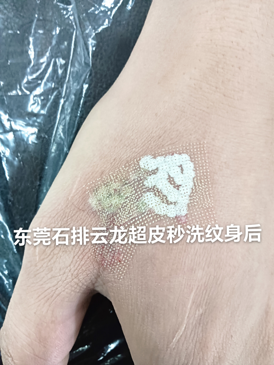 高端超皮秒 点阵清洗纹身,包洗干净,不留疤痕,无效退款,签约保证.