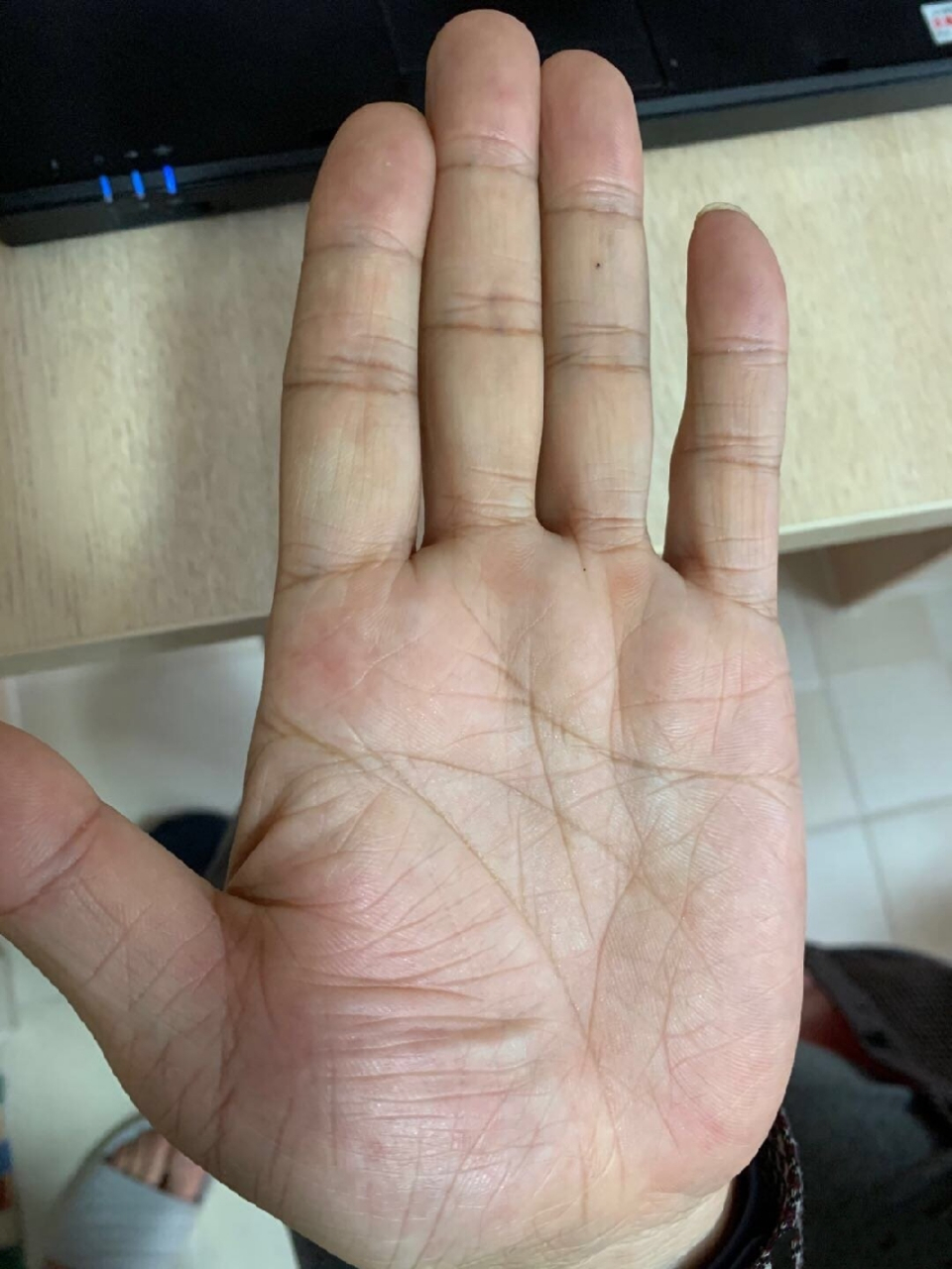 手诊23 木型手. 注意心脏,十字纹已经出现.