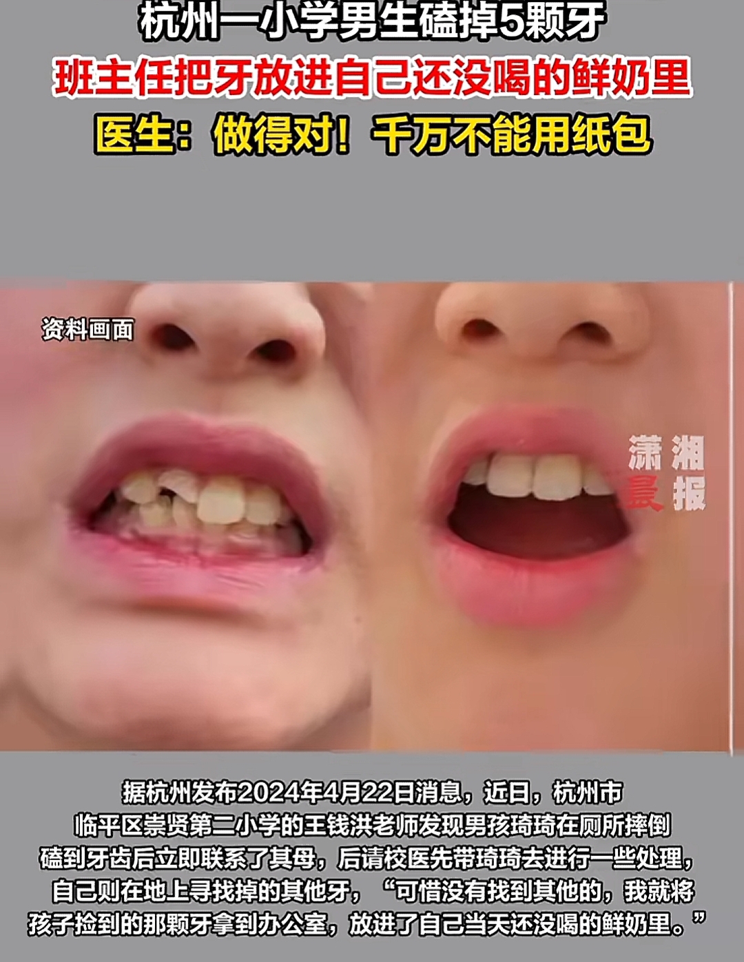 杭州小学生不小心磕掉5颗牙,被班主任直接放进未喝