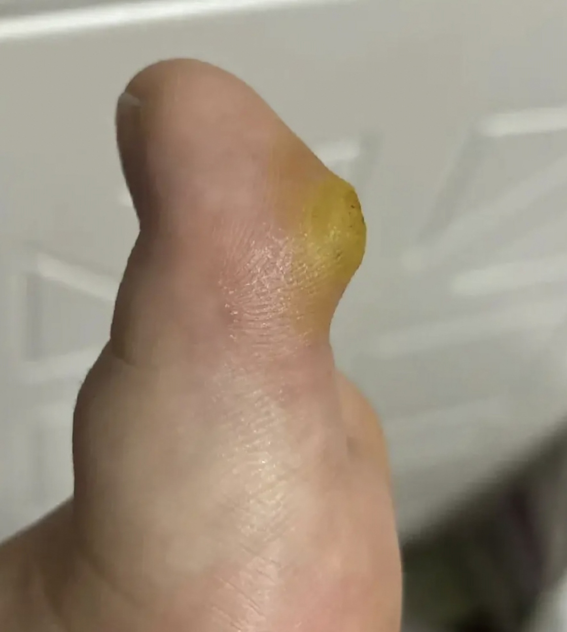 我姐脚上长了个鸡眼,去医 院挂了外科