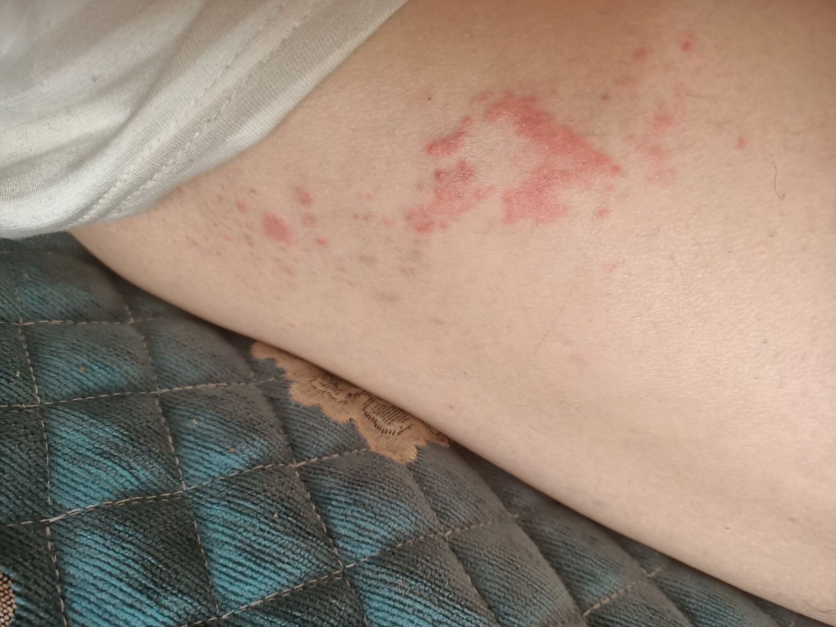被蜘蛛咬过一次,治好了后来每年都起这样的疙瘩,这是什么?