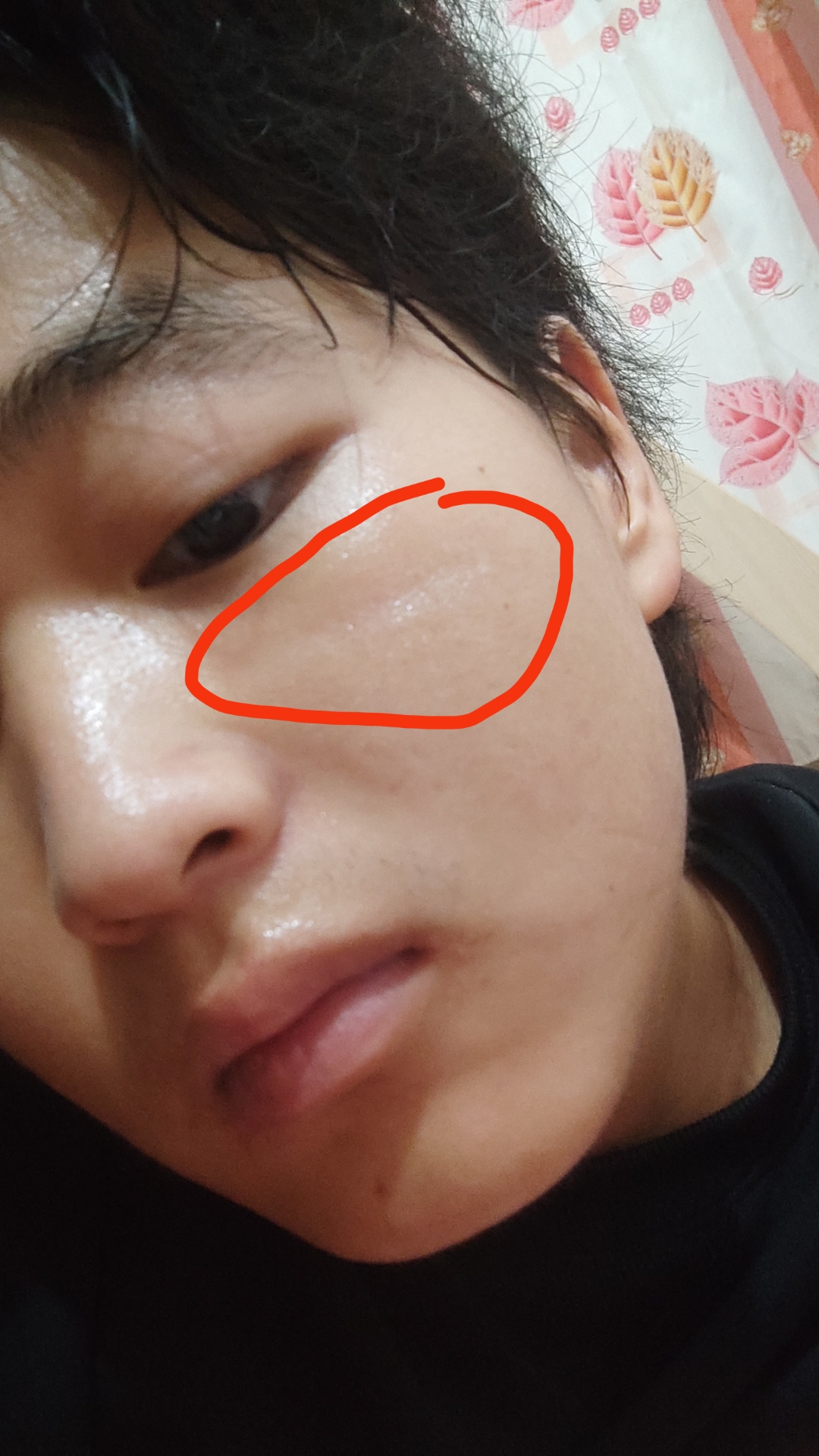 这个凹陷是怎么回事啊?求解答