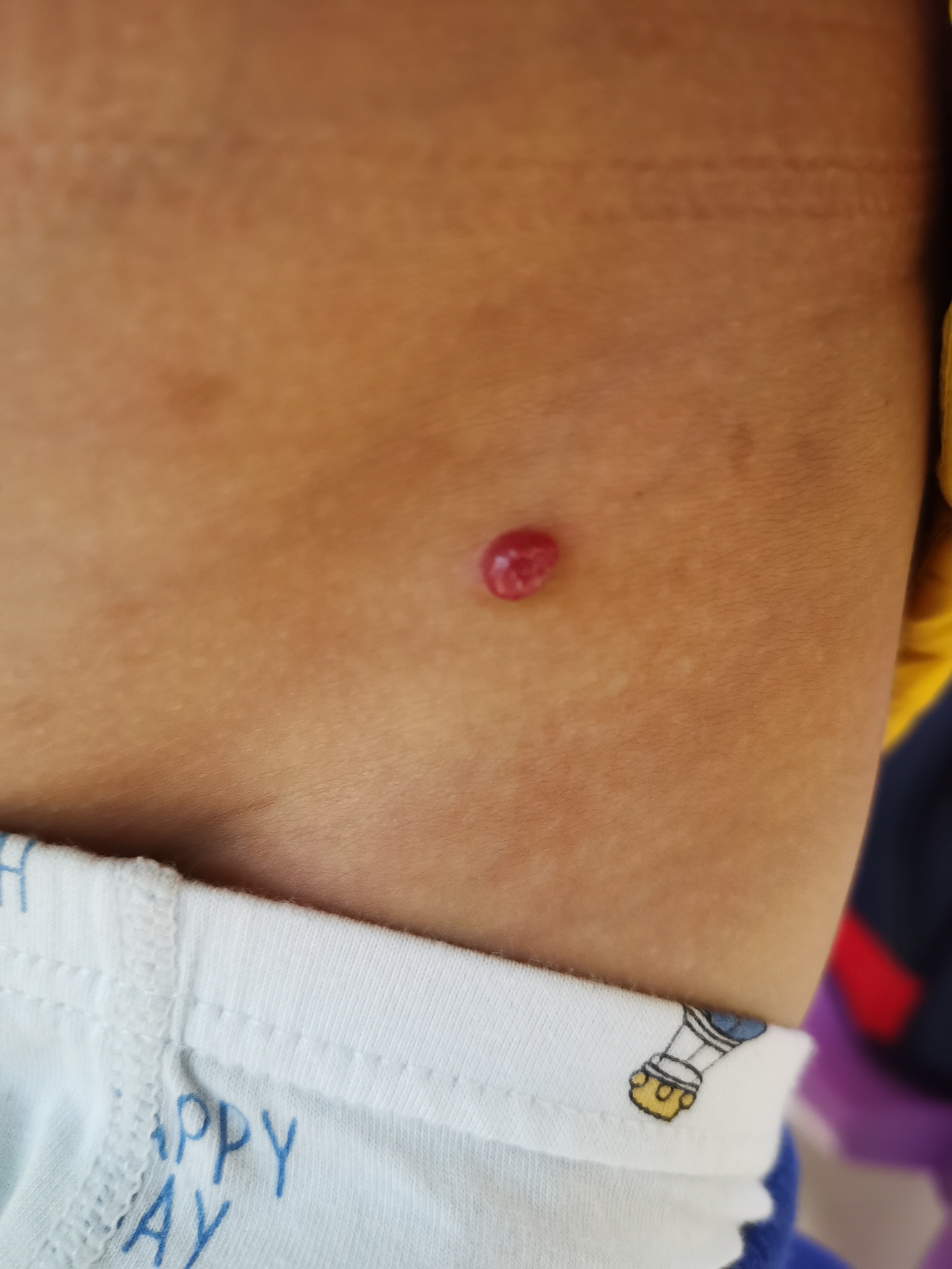 这种是血管瘤吗,该怎么治?