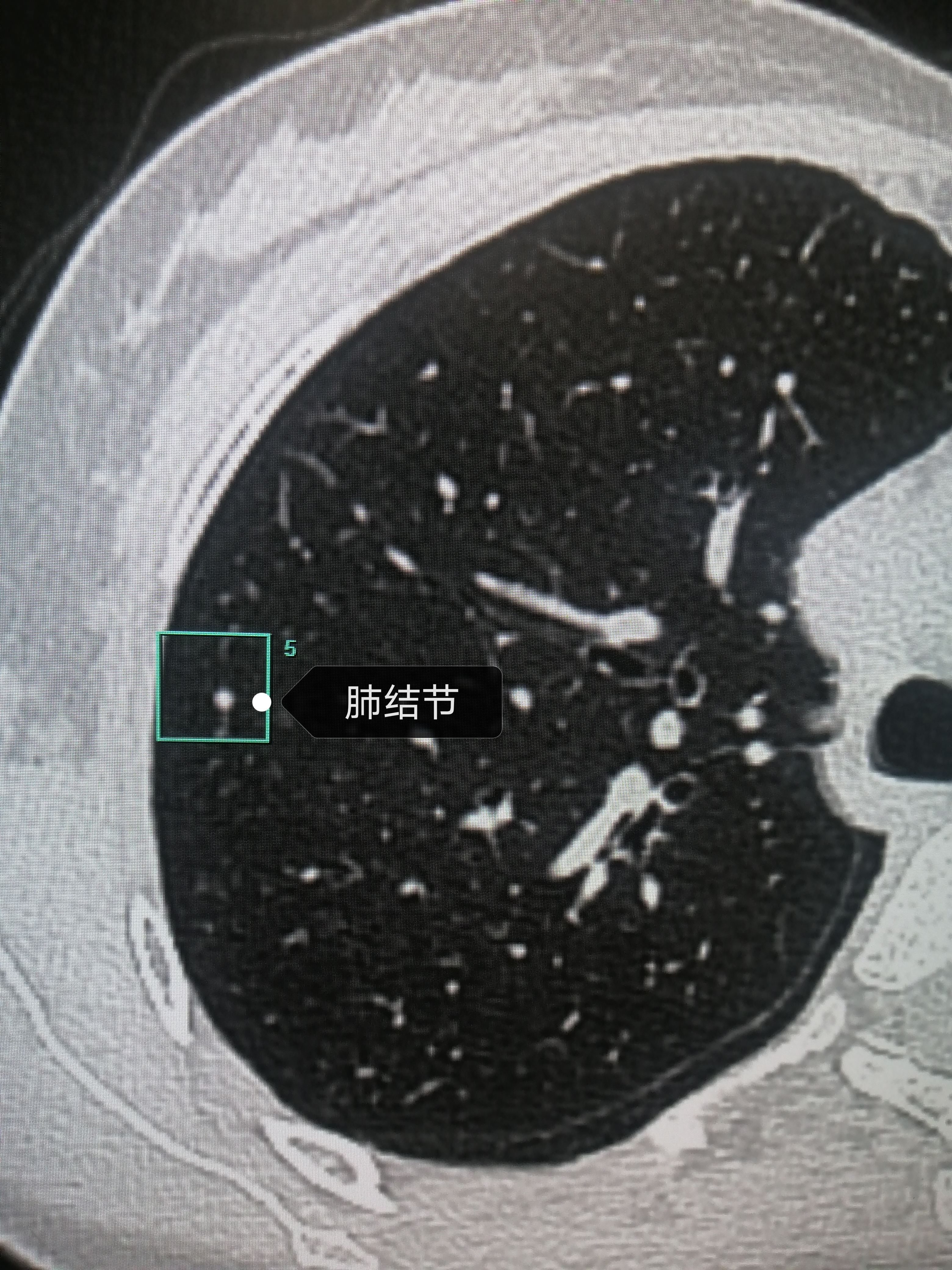 肺结节病ct图片图片