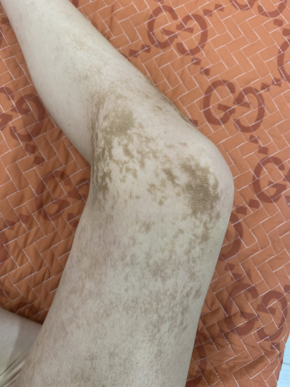 皮肤病 这是什么皮肤病,只有右边腿上脚脖上等地方有不疼不痒的,有没