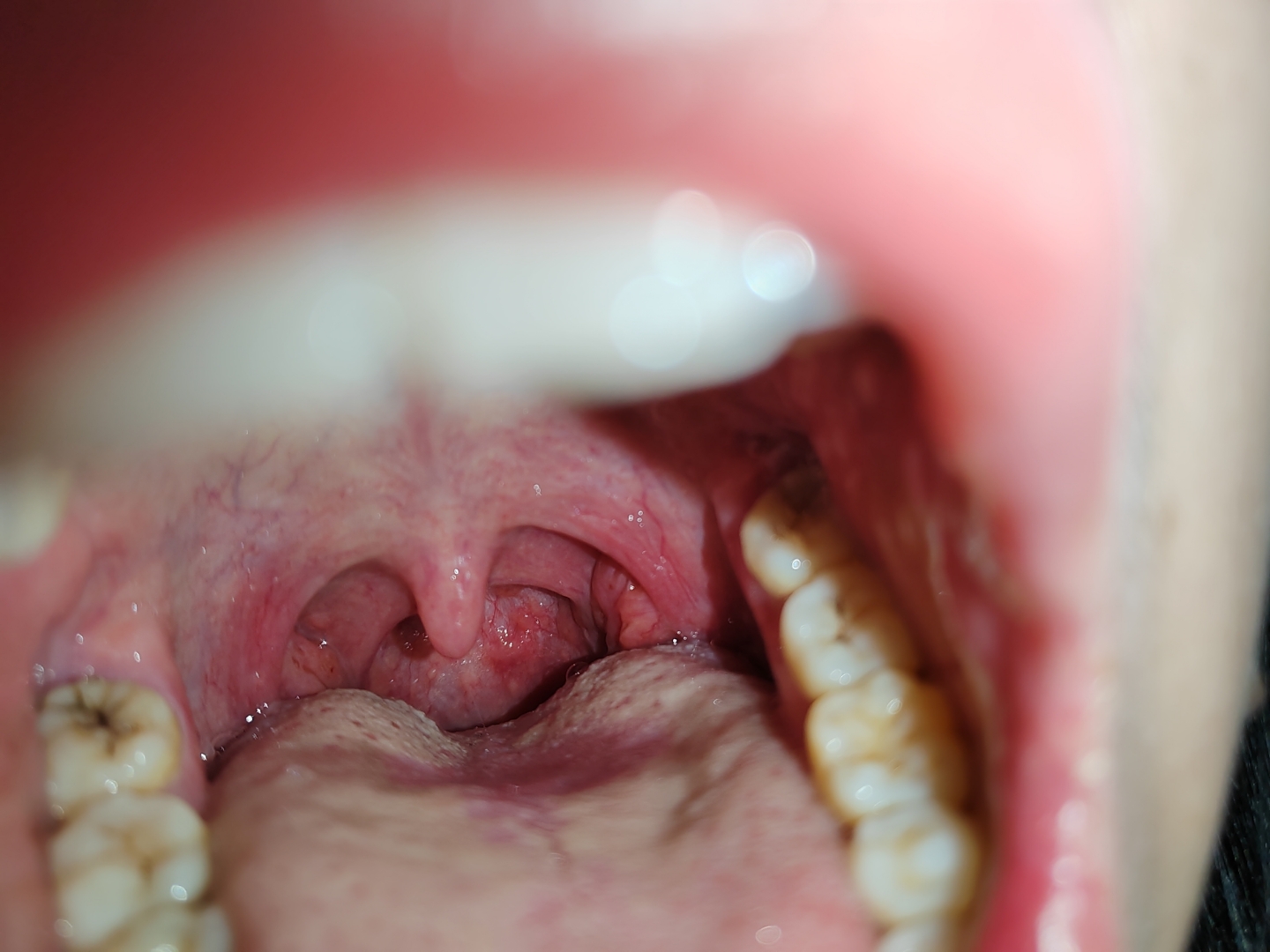 慢性咽喉炎,经常咽喉壁起泡,怎么办?