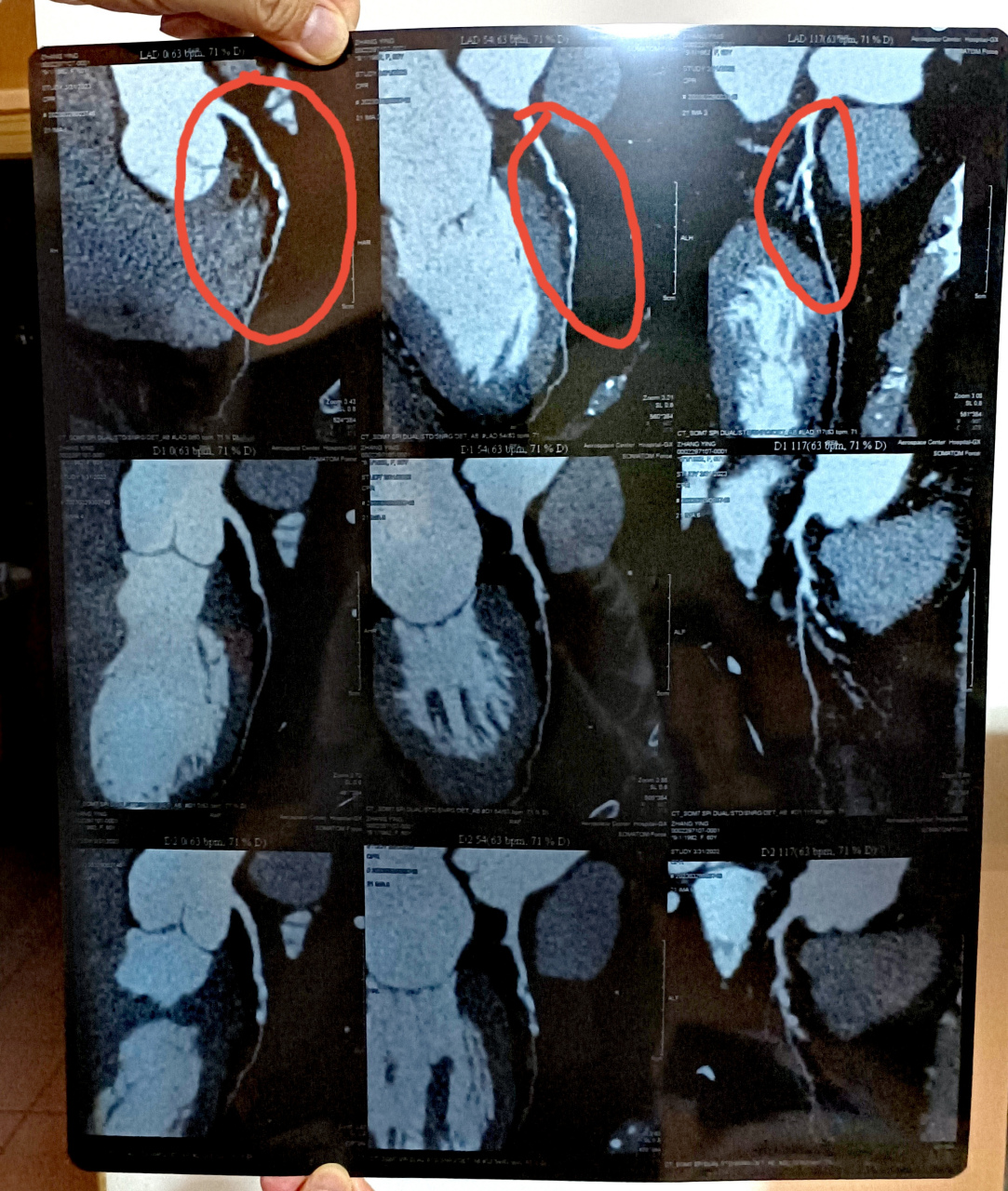 我做了心脏冠脉ct,报告显示:左前降支中段管壁可见钙化,非钙化斑块,管