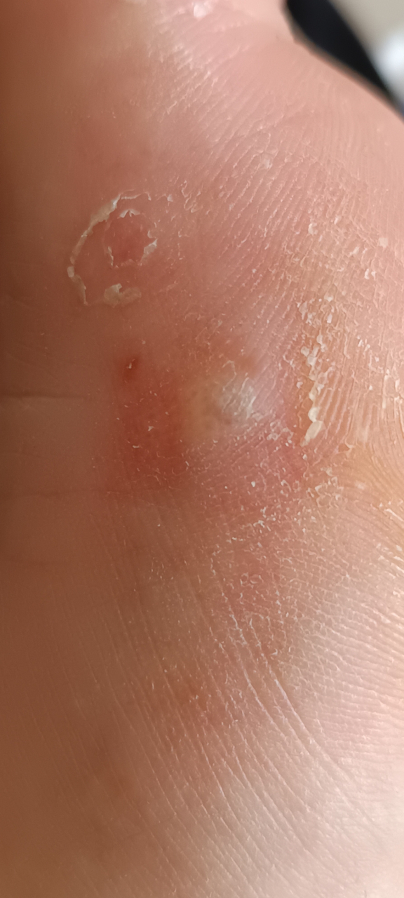 请问一下水泡型脚气怎么办?