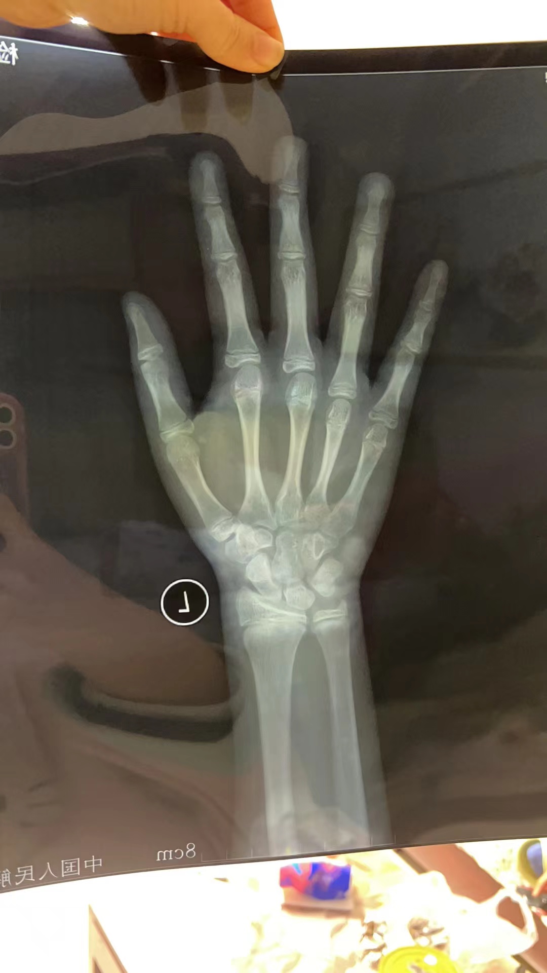 有没有大神帮忙看看孩子的骨龄,今年9岁.来例假了. 身高目前1.