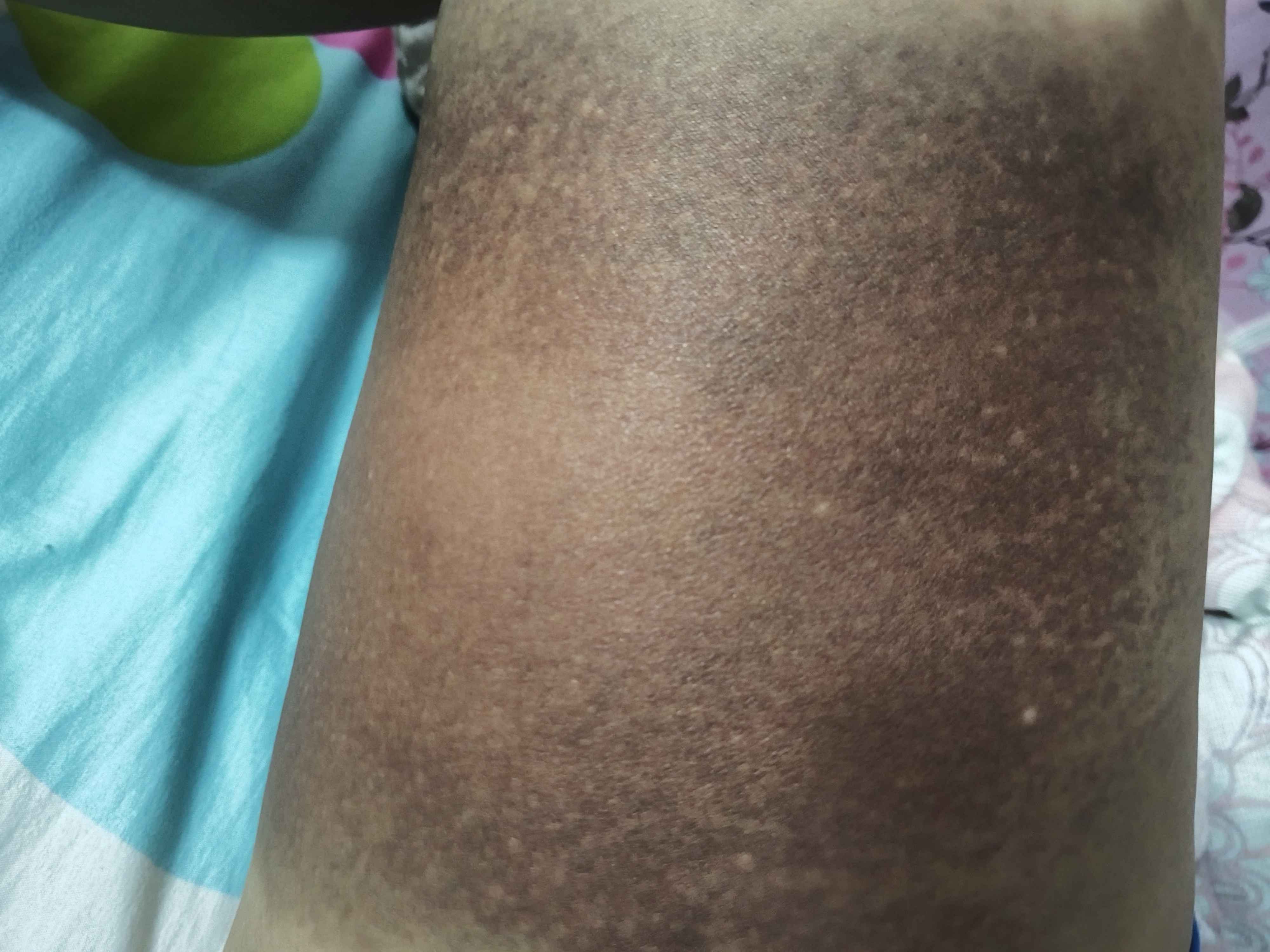 大腿撞伤6天后出现紫黑色,要怎么处理