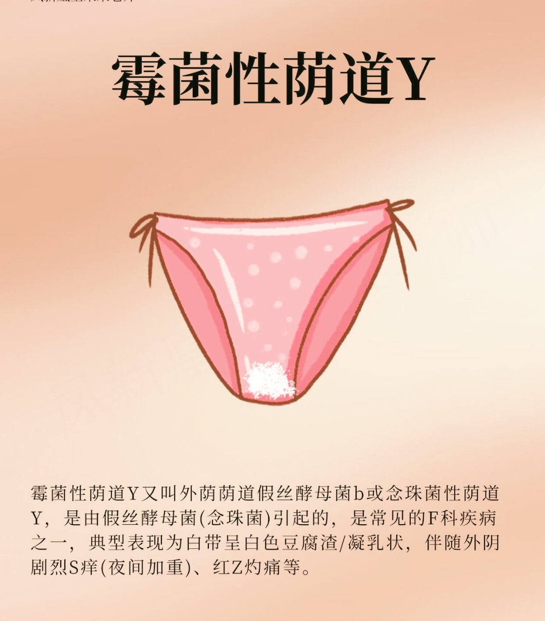 霉菌性荫道炎由念珠菌引发,典型症状为豆腐渣白带,外阴剧痒灼痛,夜间