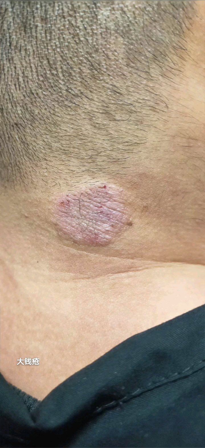 大钱疮