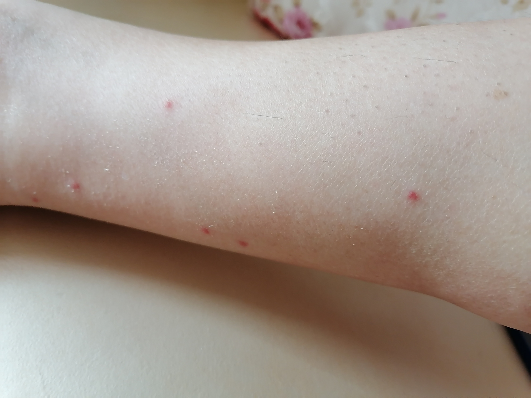 为什么脚上会起红色的疹子百科在线