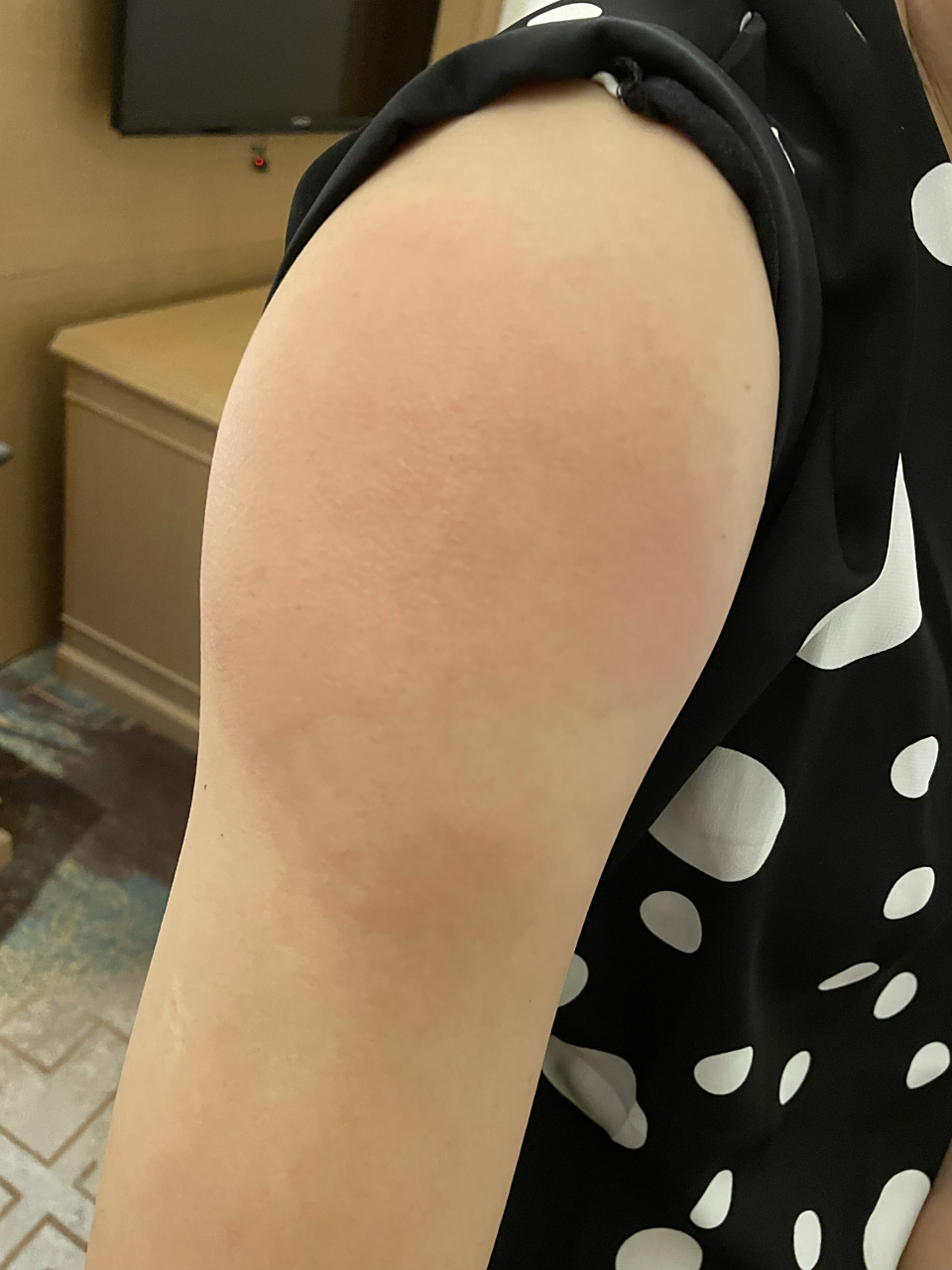 这就是我打了新冠疫苗安徽智飞第三针的结果!又肿又痒又痛!