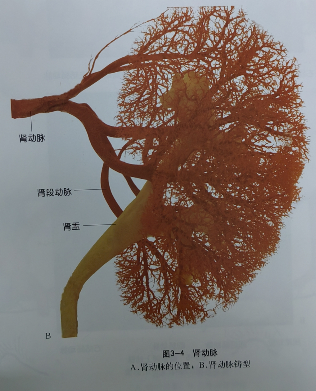 肾动脉铸型