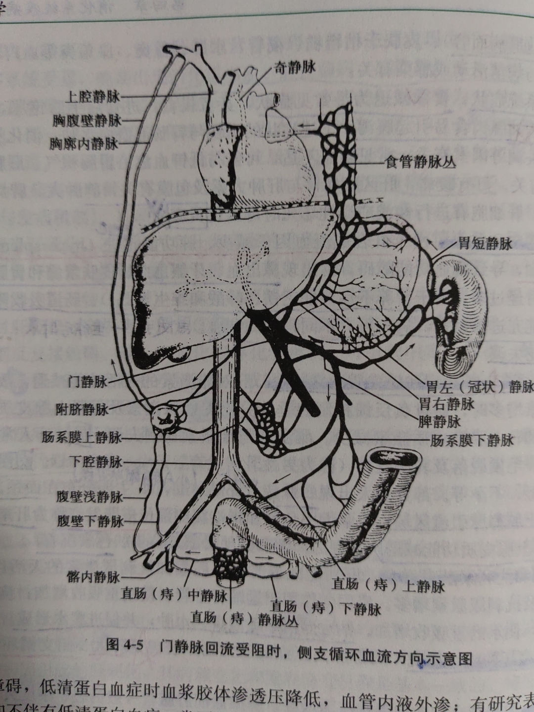 三大临床表现之一 脾大——首先出现,晚期可伴有脾功能亢进,表现为白