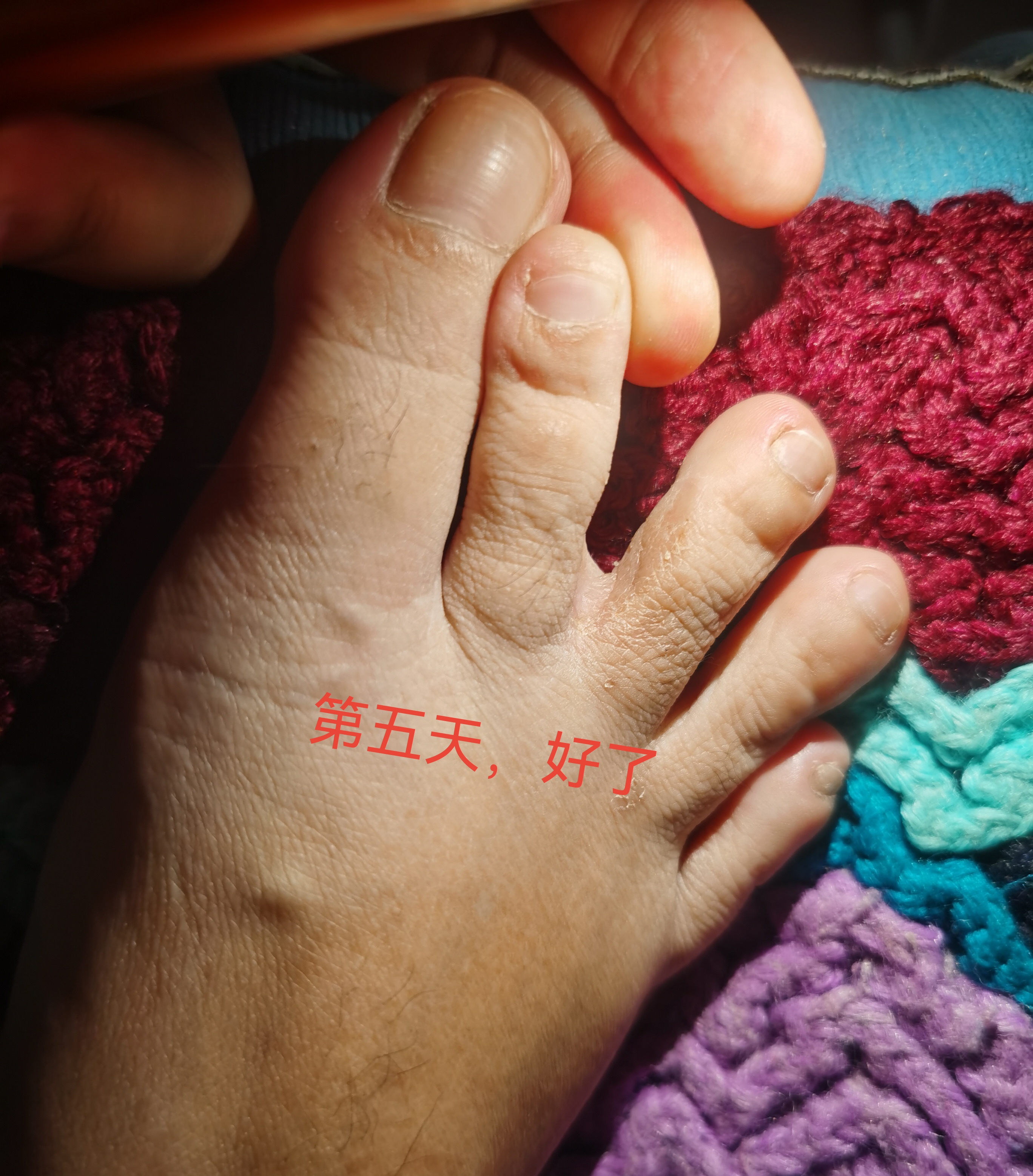 无花果片治脚气,效果看得见[高考必胜][高考必胜]#每天一个健康冷知识