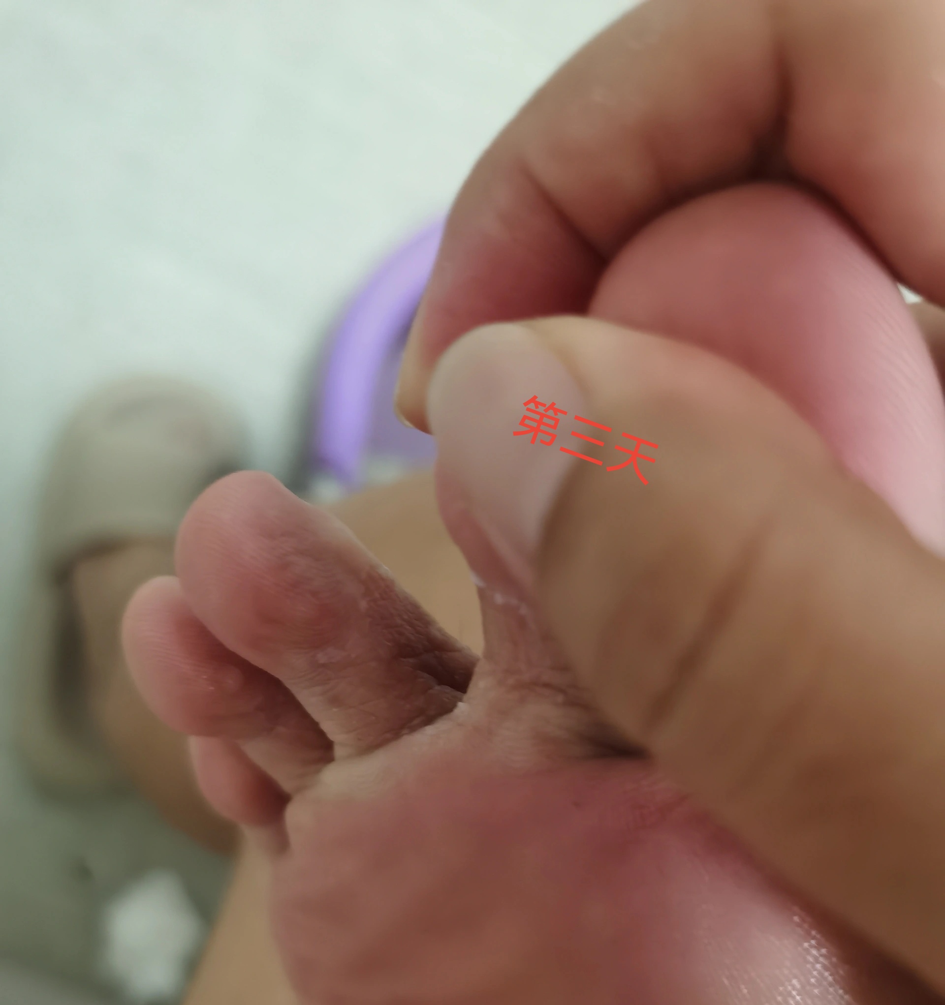 无花果片治脚气,效果看得见[高考必胜][高考必胜]#每天一个健康冷知识