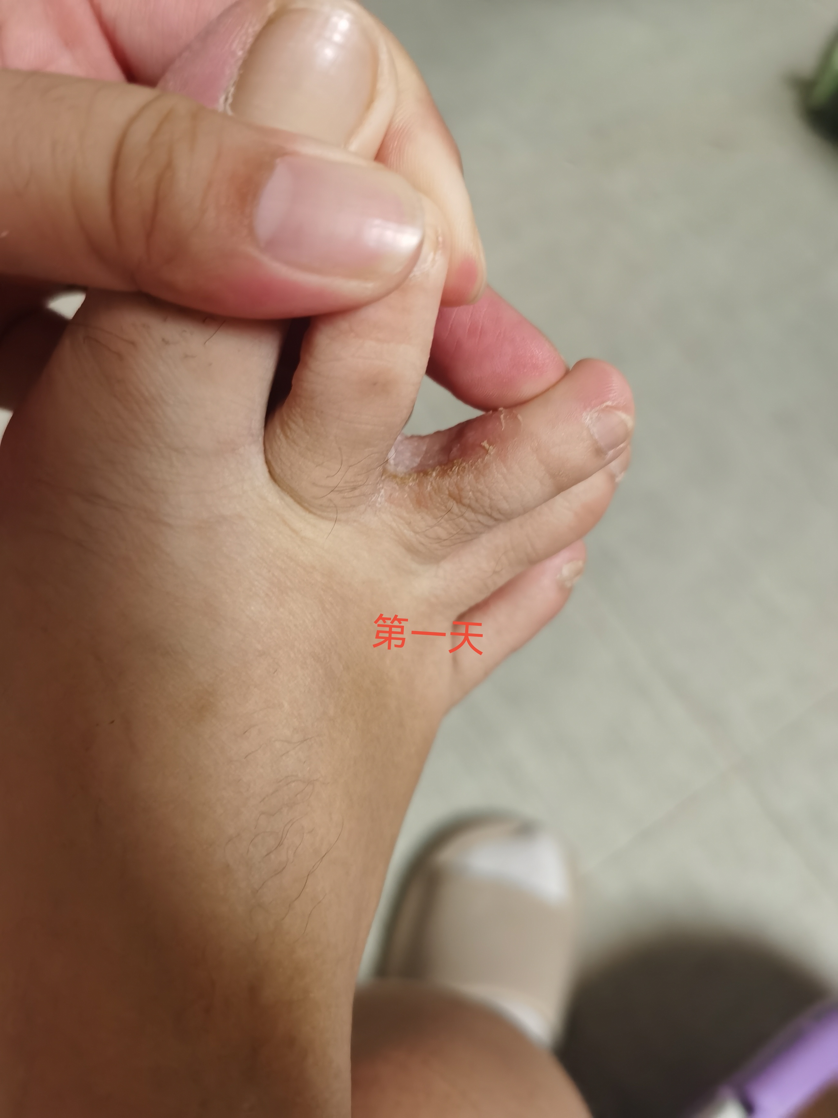 无花果片治脚气,效果看得见[高考必胜][高考必胜]#每天一个健康冷知识