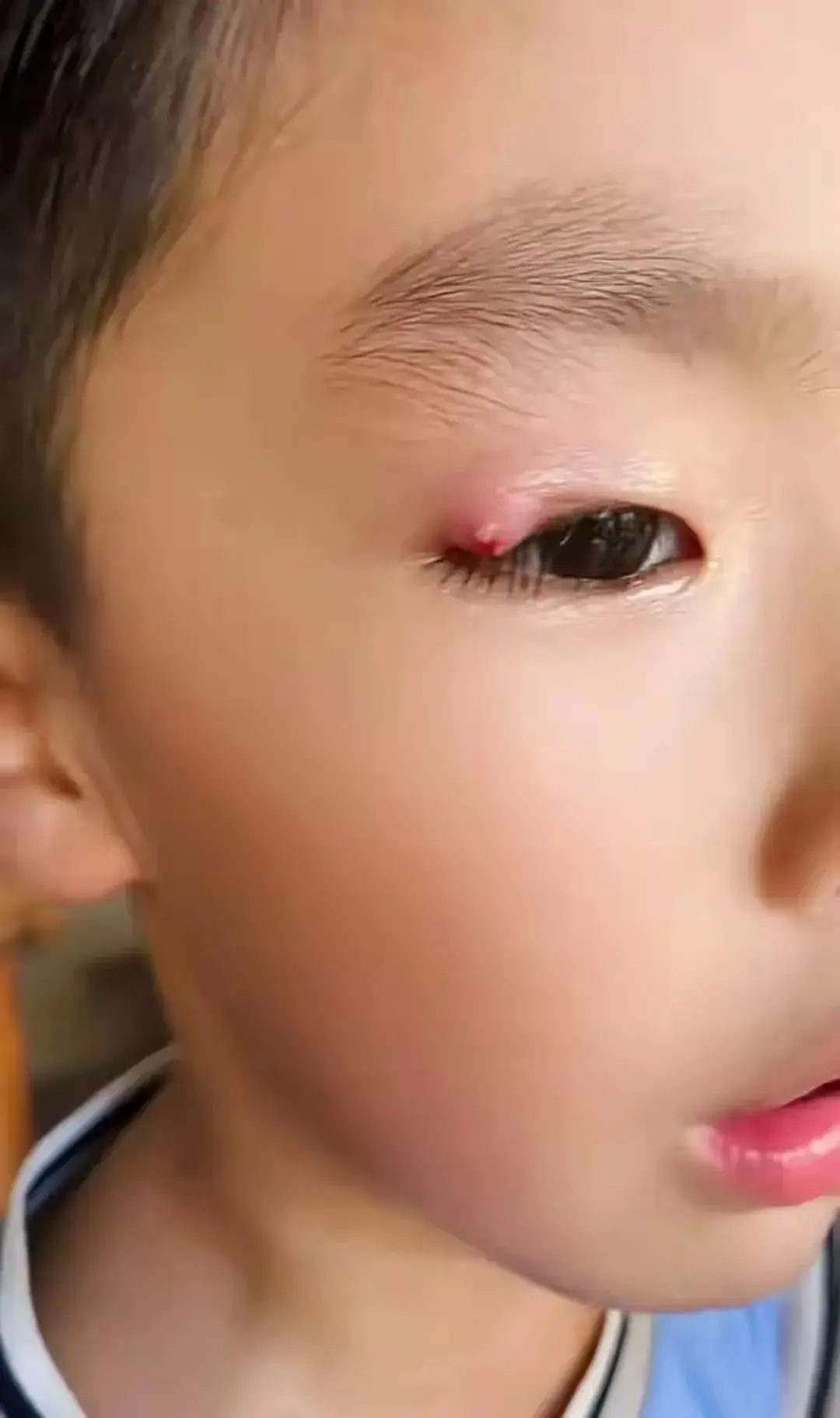 邻居家孩子眼角上长了个结子,孩子妈妈说已经10多天了,一直没有好