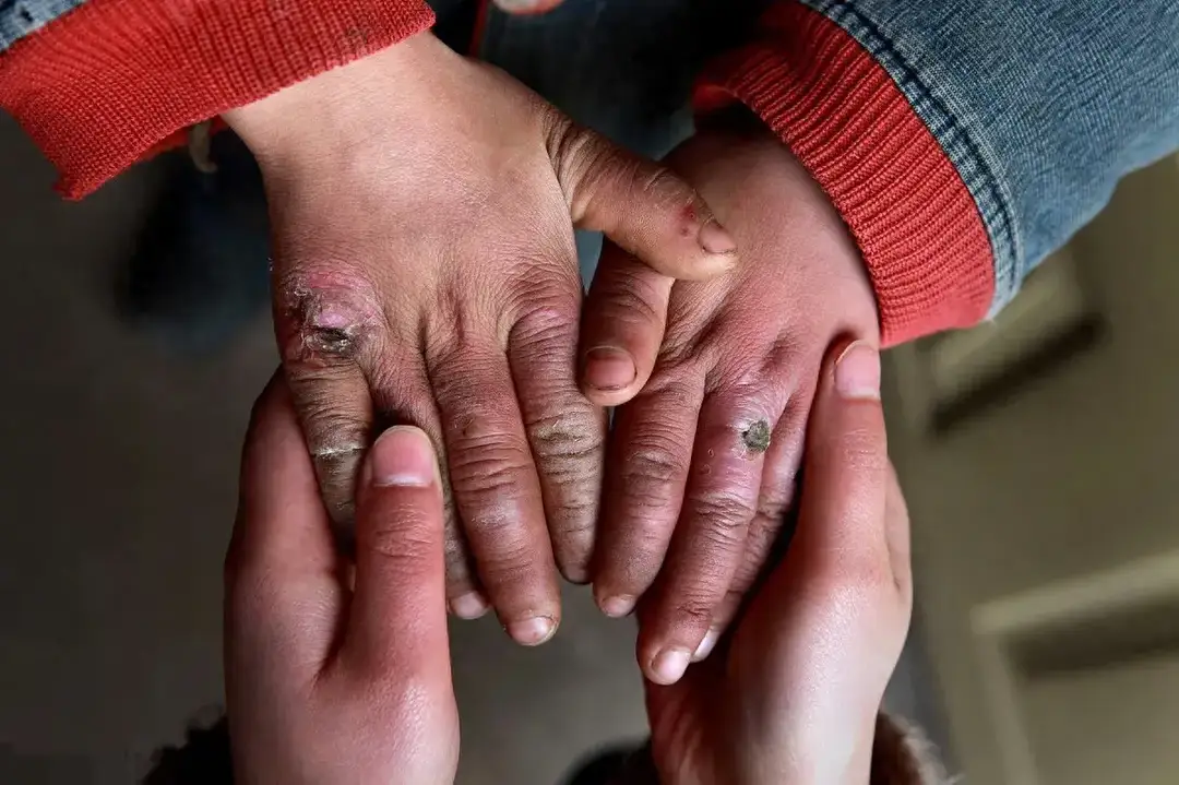 我还记得有人说『小鸟的脑子治冻疮,还跟她一起捡过冻死的小鸟