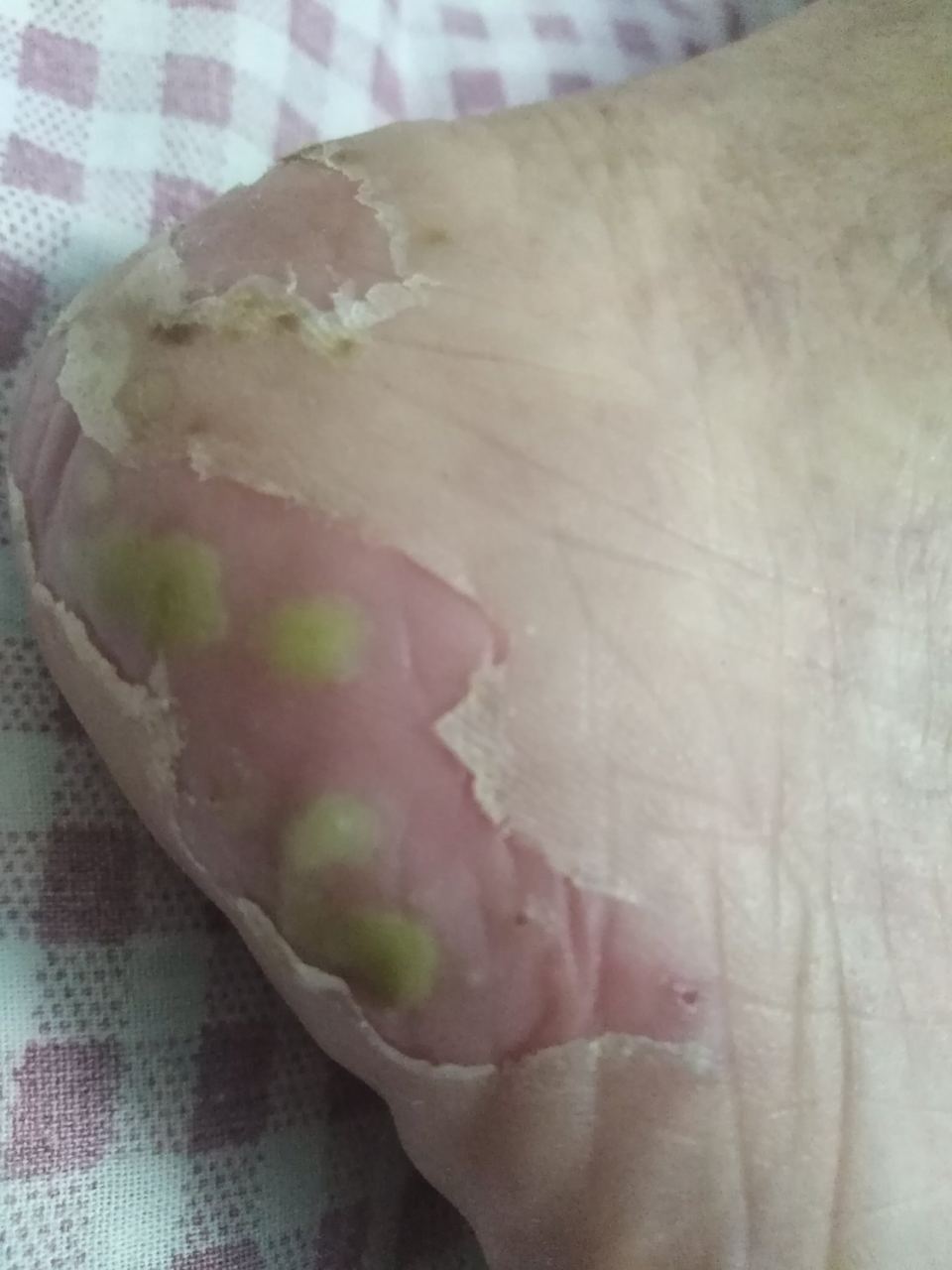 脚后跟长脓包反反复复是怎么回事,请大家指教