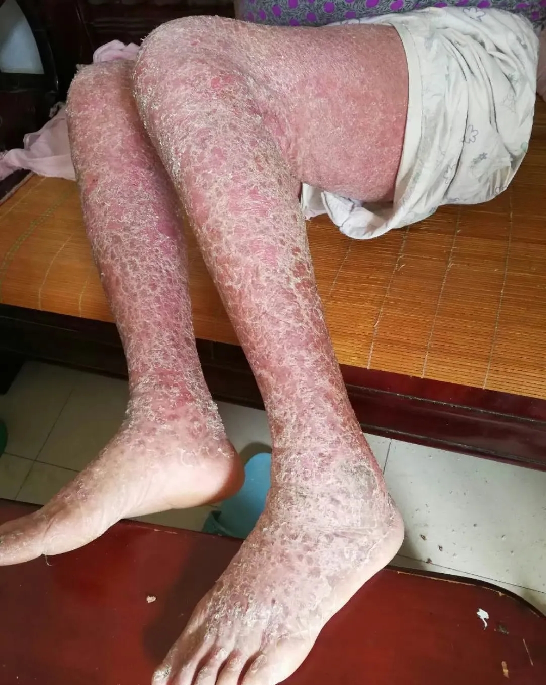 中医五行视角下银屑病患者维生素补充策略