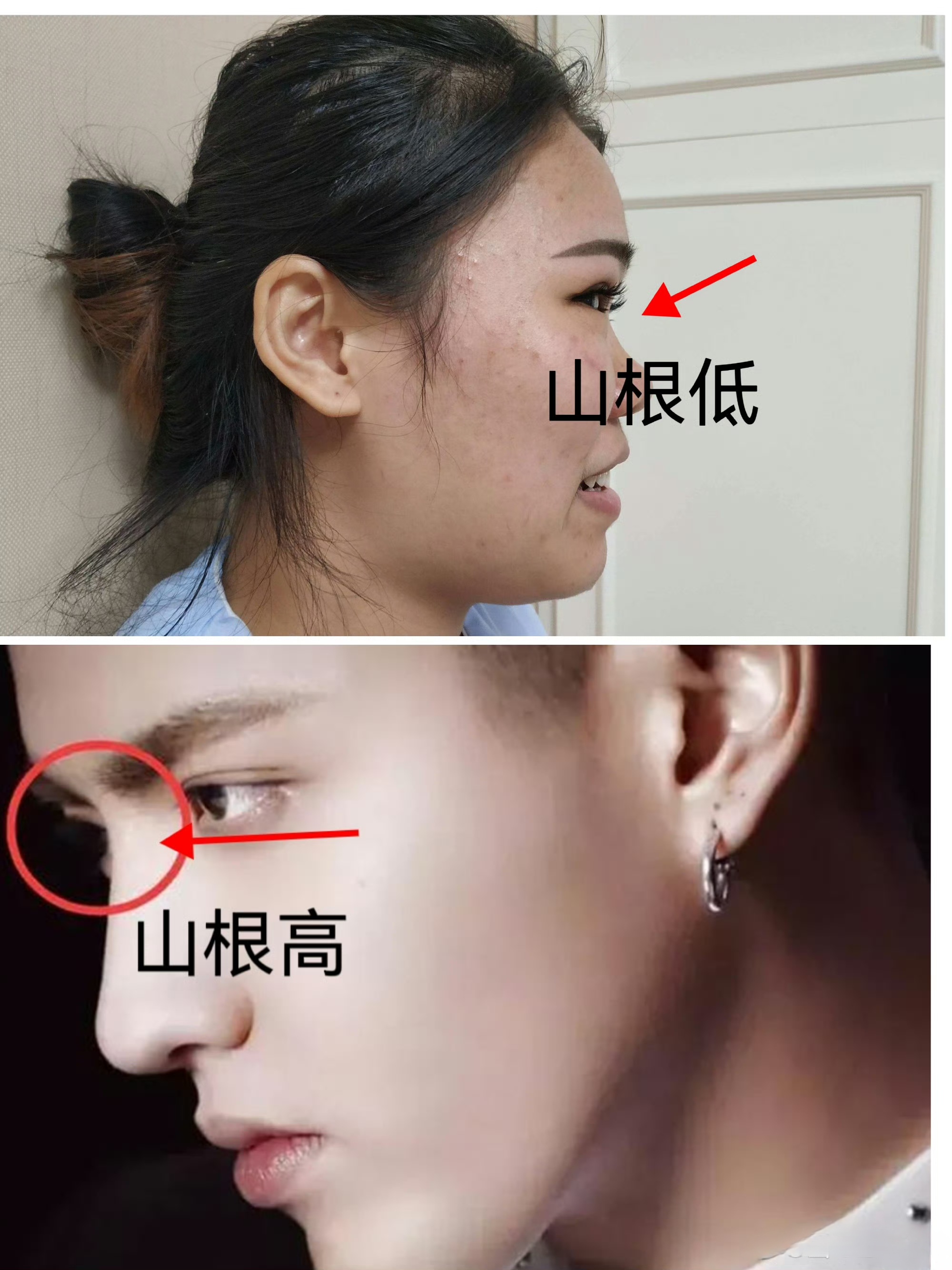 哪里是山根?