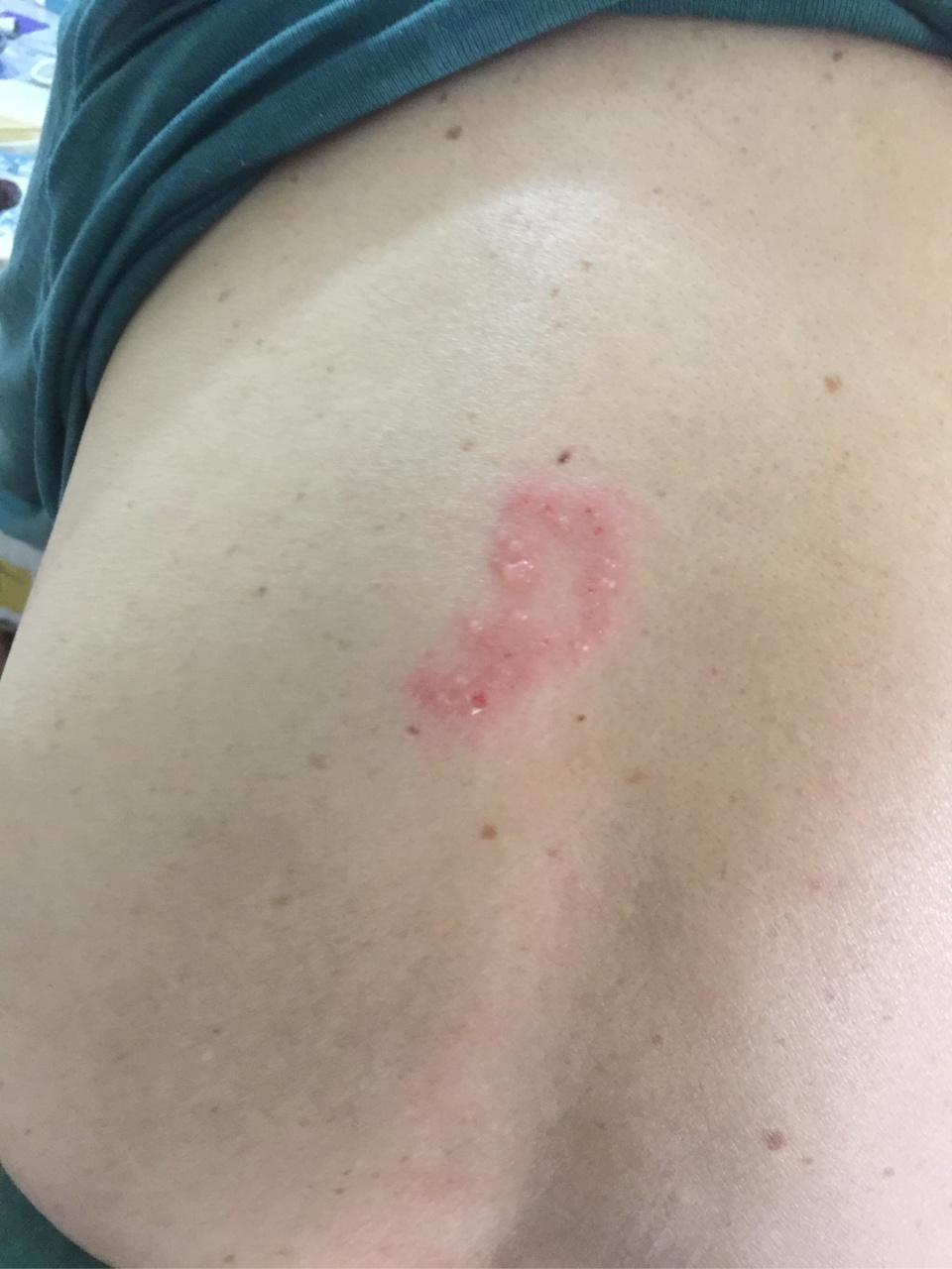 老人后背突然起红疙瘩,不摸不痛,也不痒,这是什么问题?