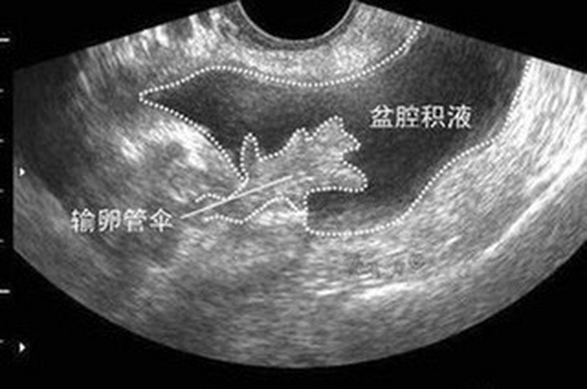 今天来一个盆腔积液就诊的病人,超声提示盆腔积液有5.