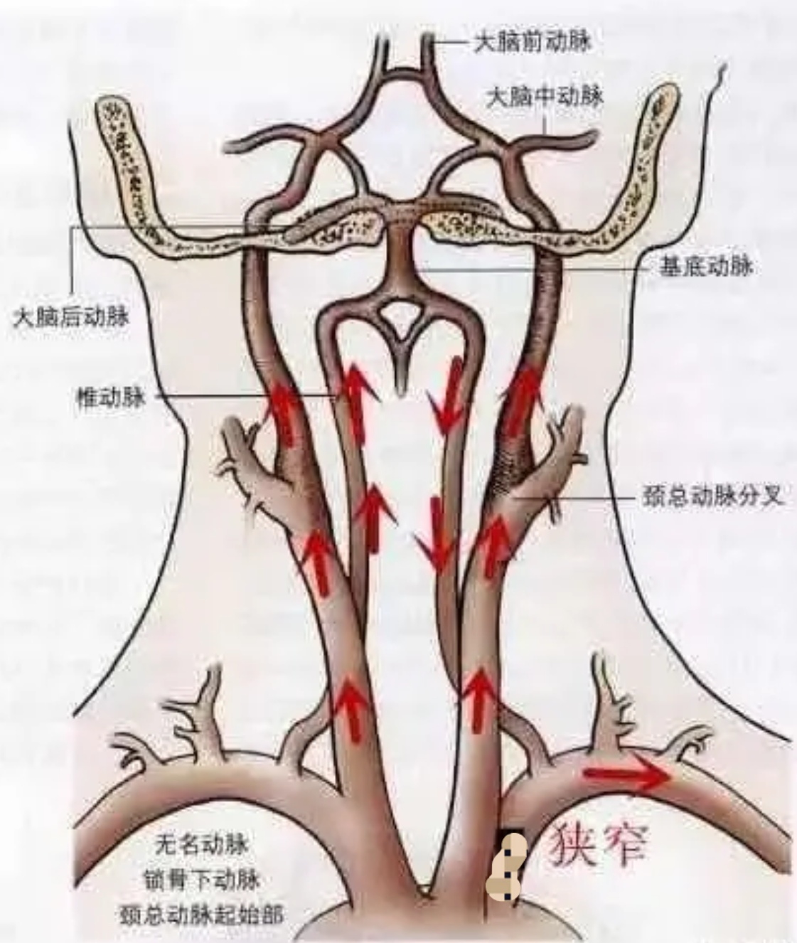 动脉导管未闭解剖位置图片