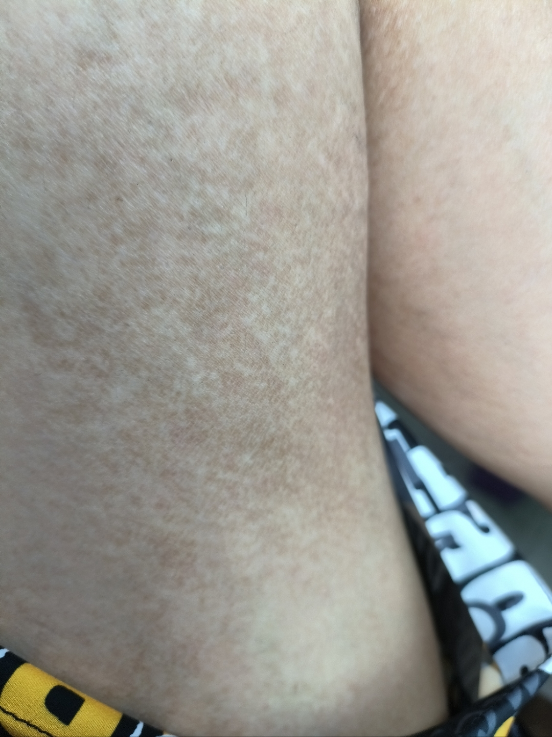 大腿周围长这个  什么?