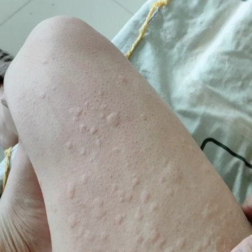 想问问各位朋友,身上突然起了这样的疙瘩,究竟是啥原因啊?